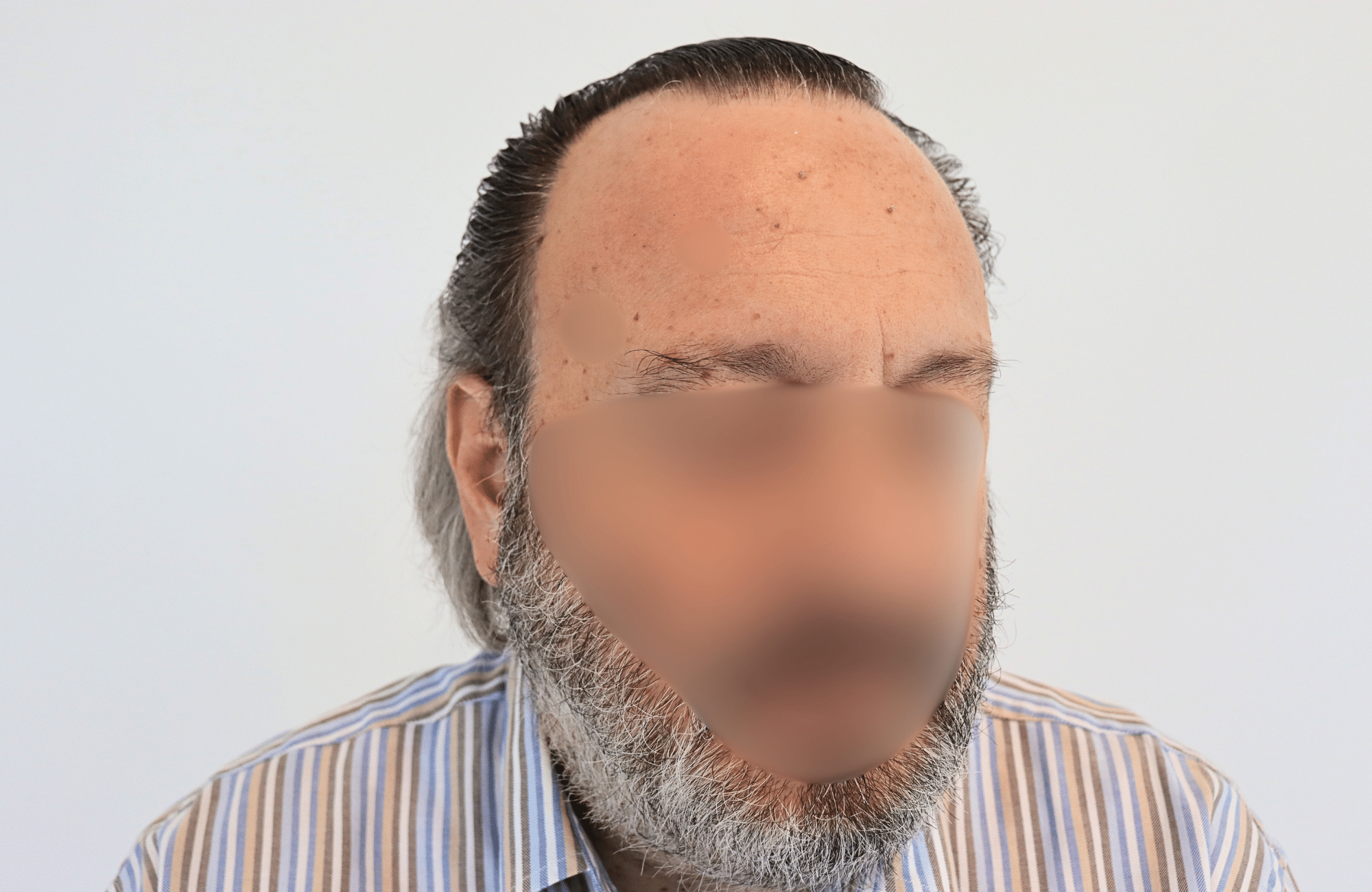 hair transplant result (2)