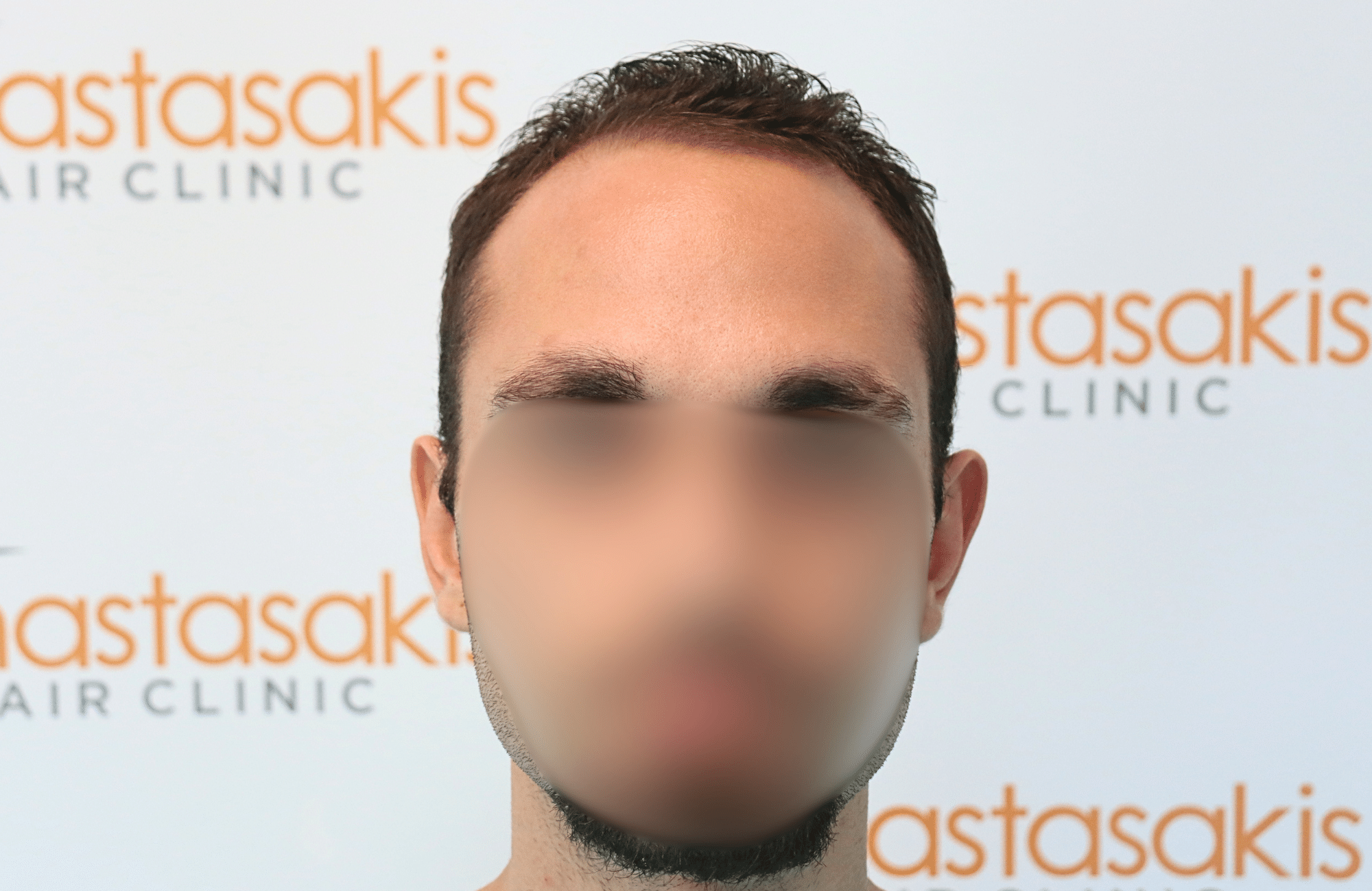 hair transplant result 2000 fus (1)