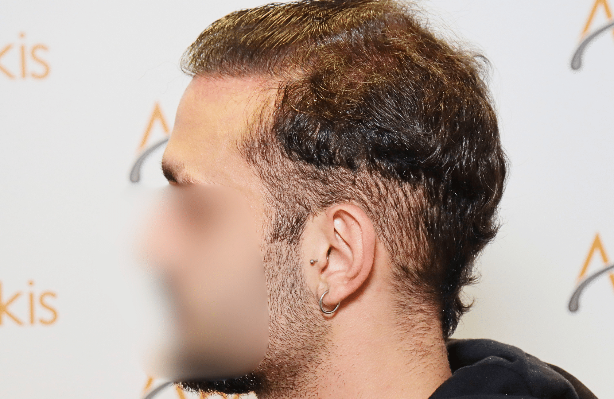 hair transplant result 2000 fus (10)