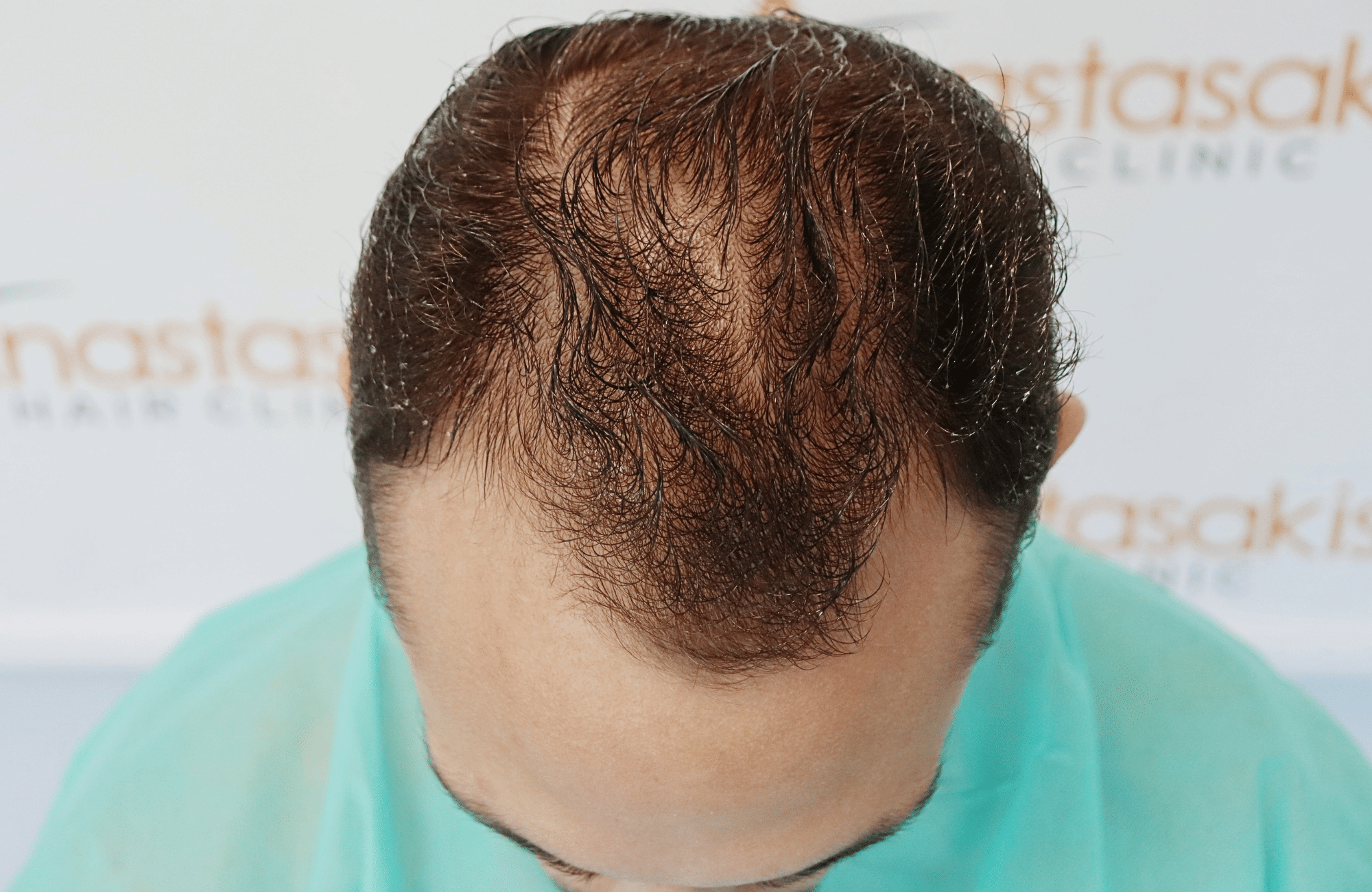hair transplant result 2000 fus (11)