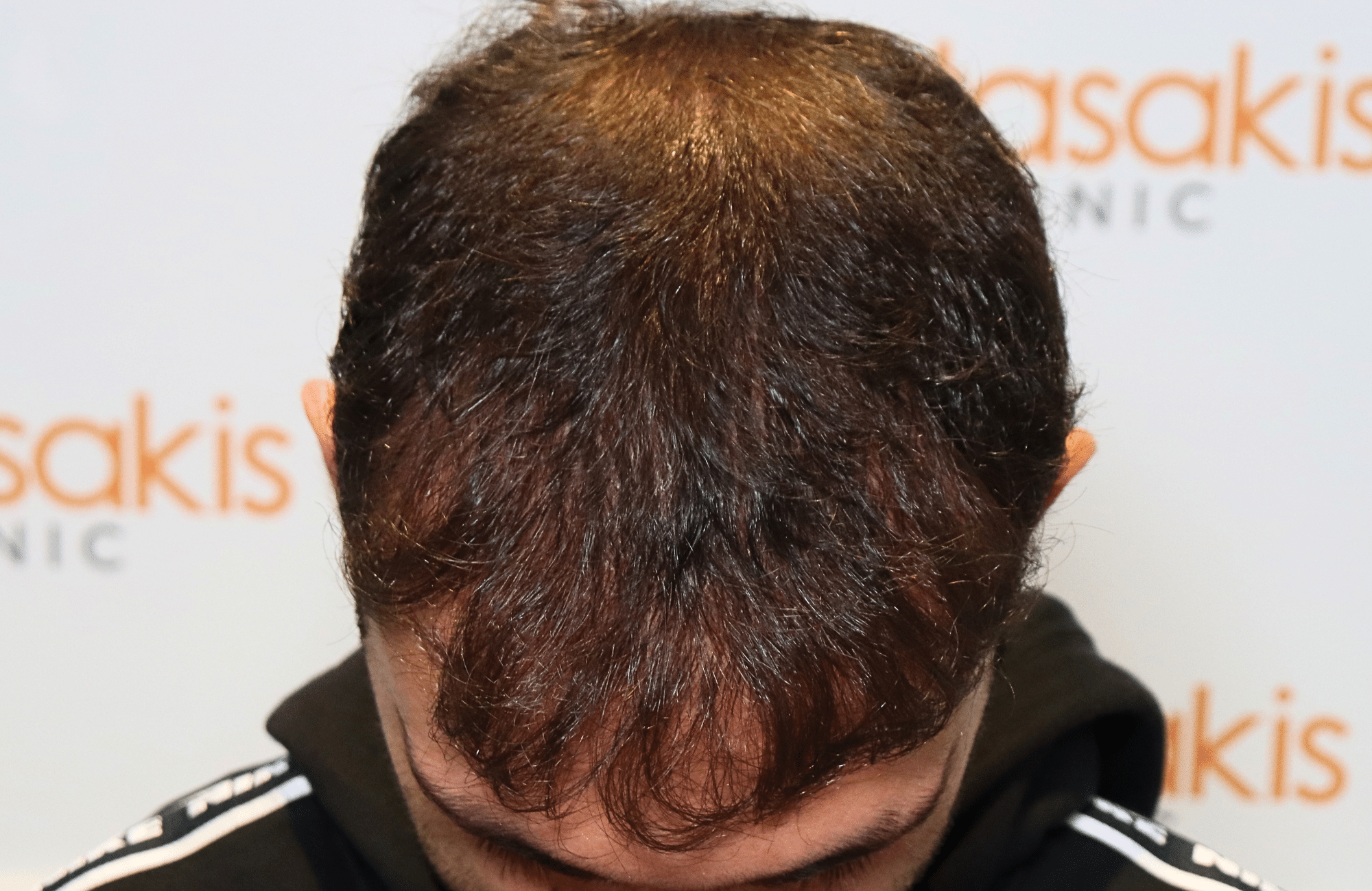 hair transplant result 2000 fus (12)