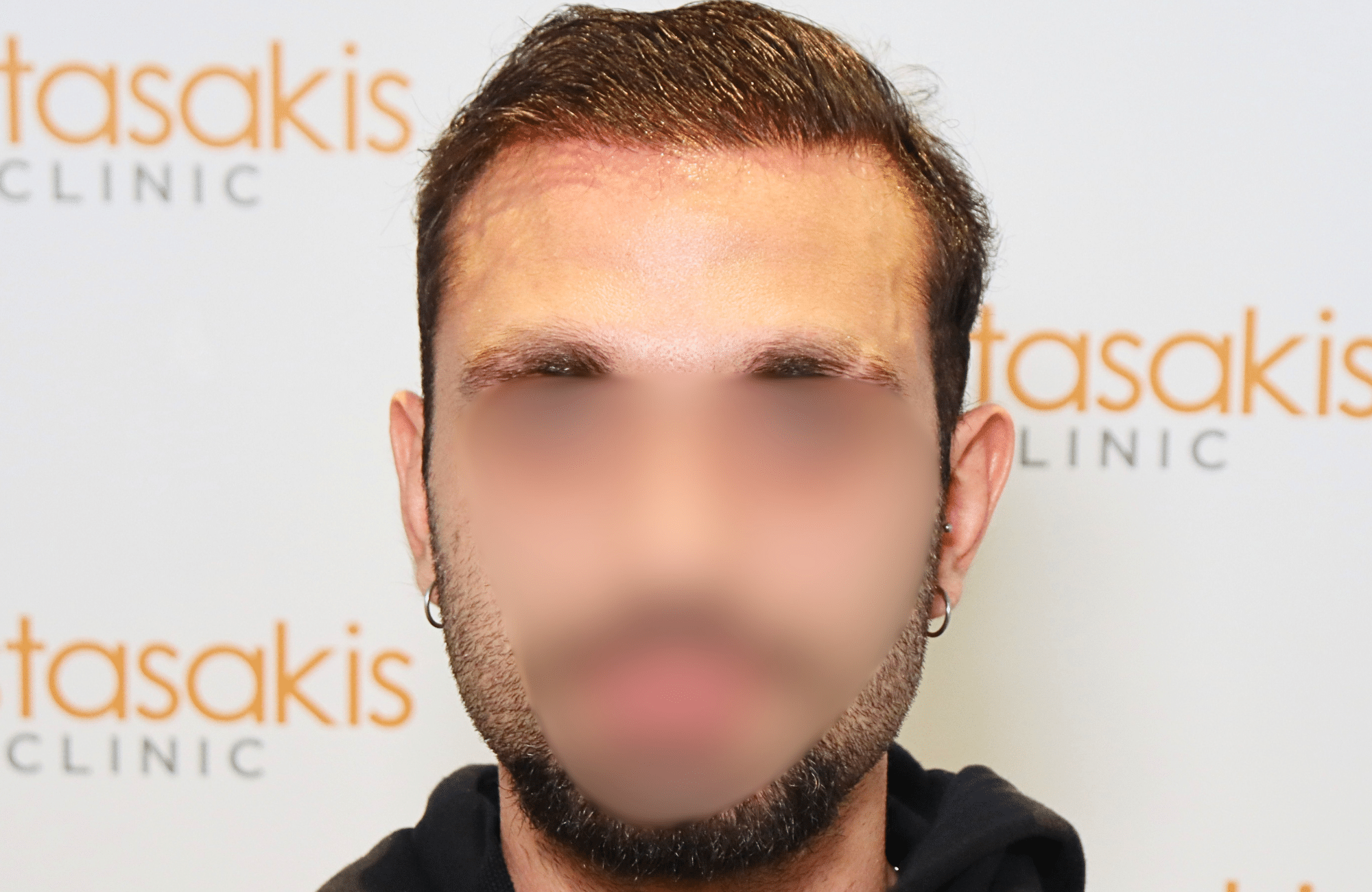hair transplant result 2000 fus (13)
