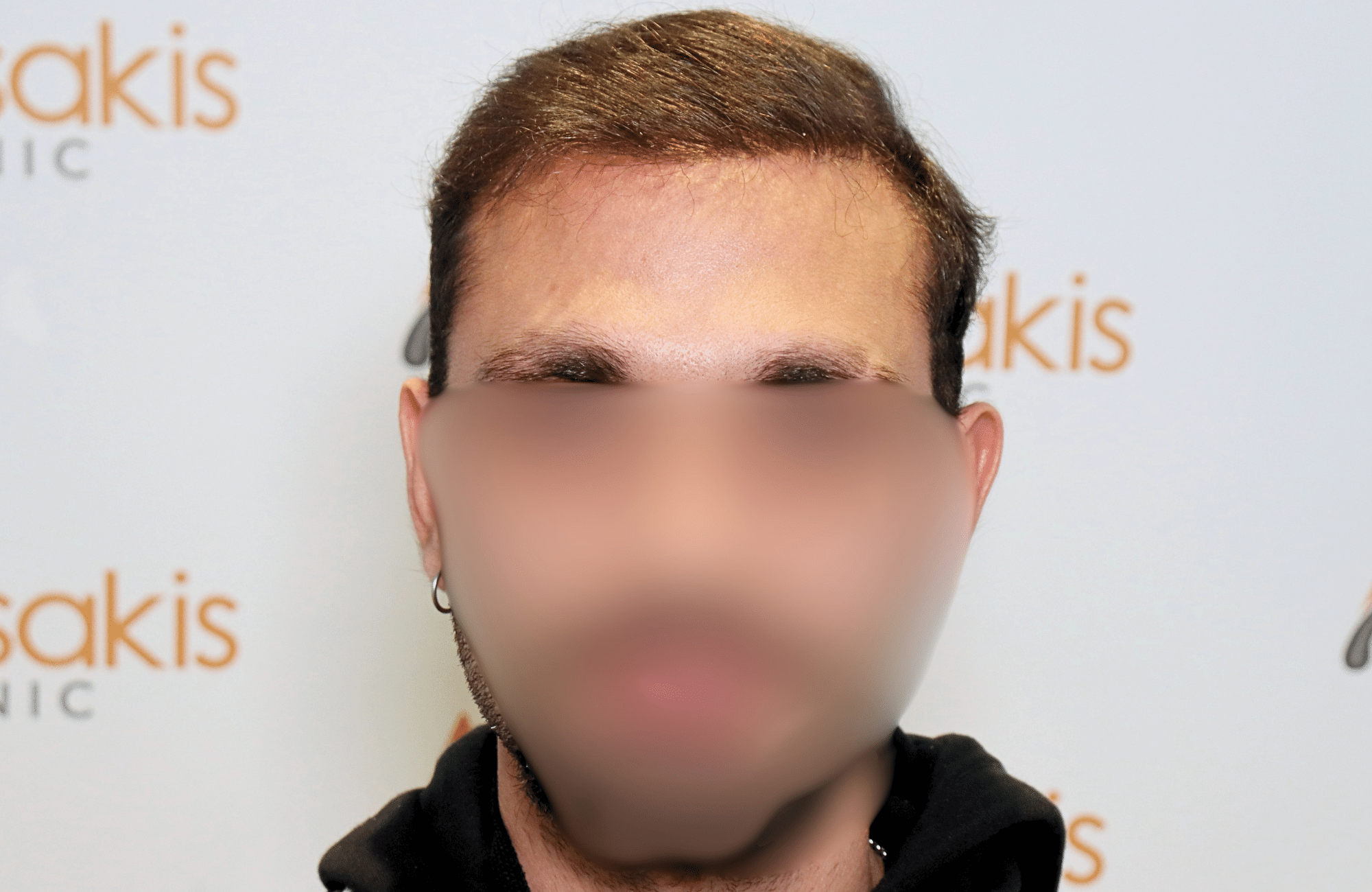 hair transplant result 2000 fus (2)