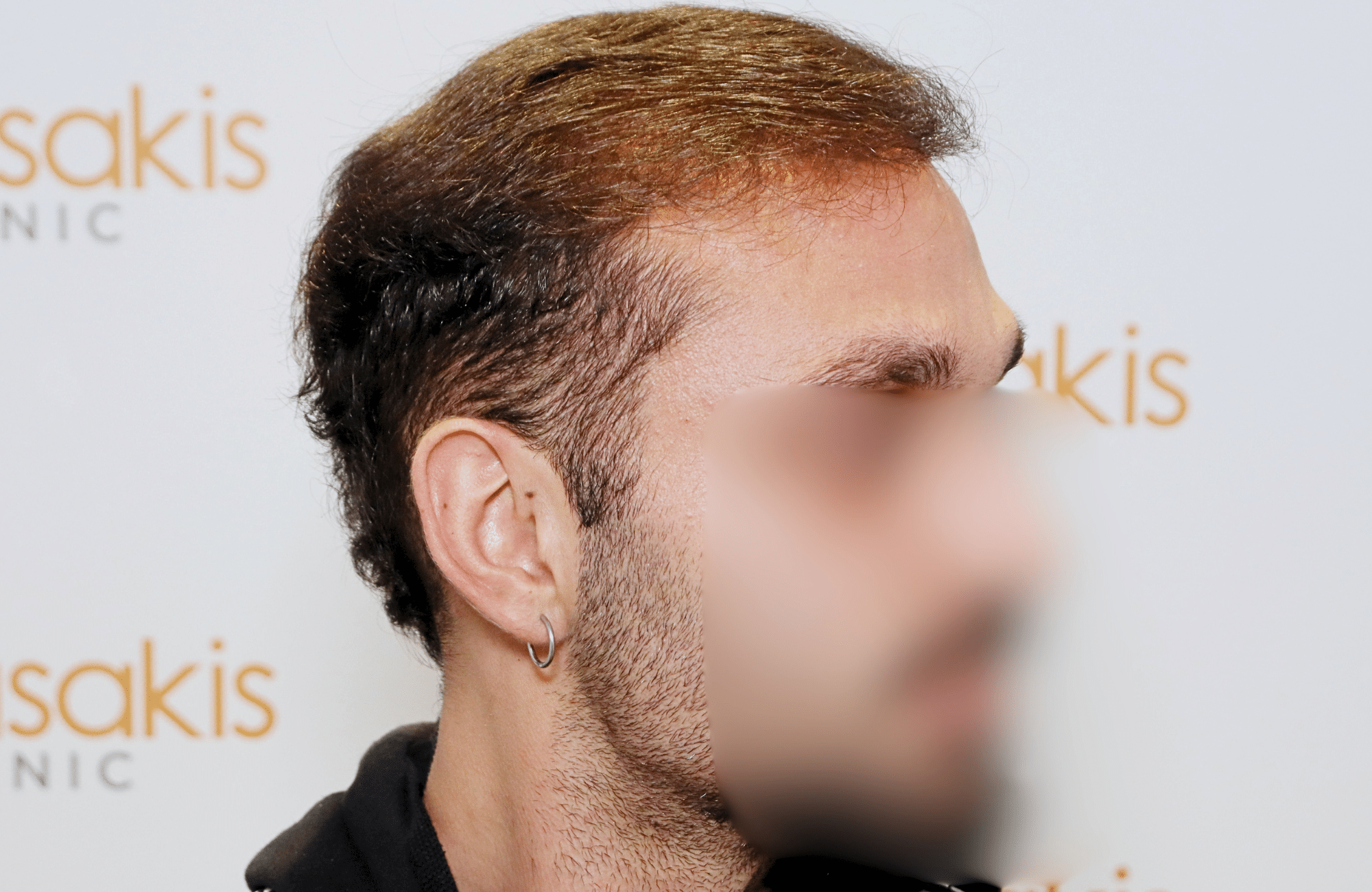 hair transplant result 2000 fus (4)