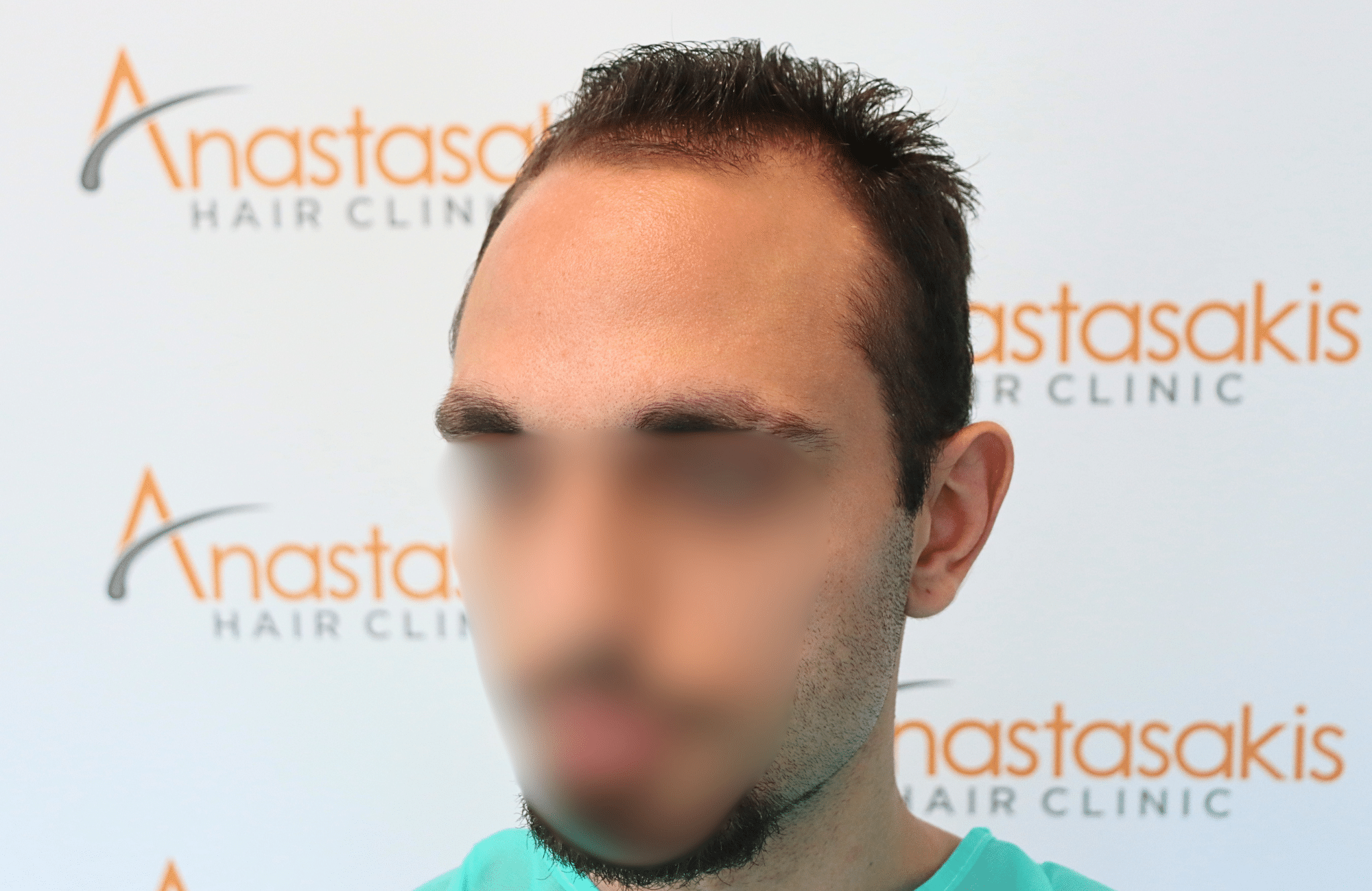 hair transplant result 2000 fus (5)