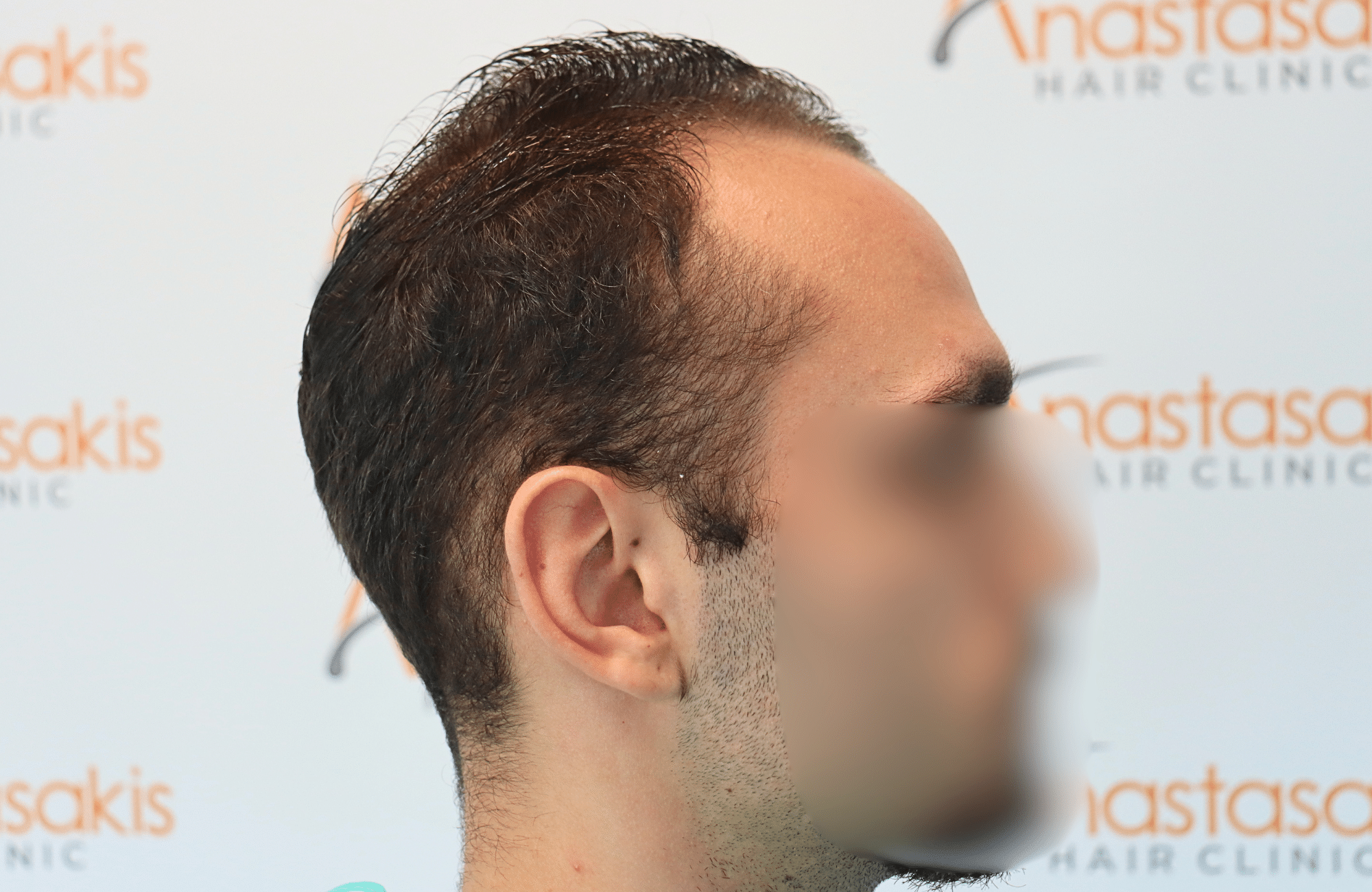 hair transplant result 2000 fus (7)