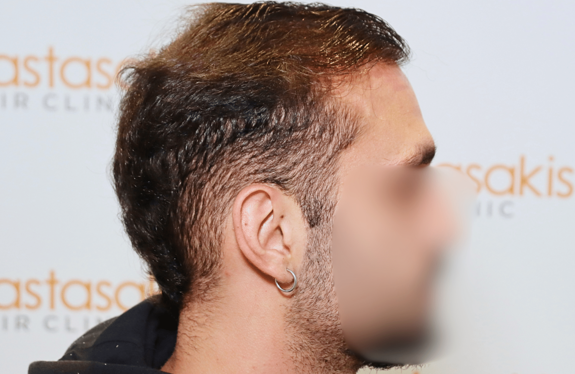 hair transplant result 2000 fus (8)