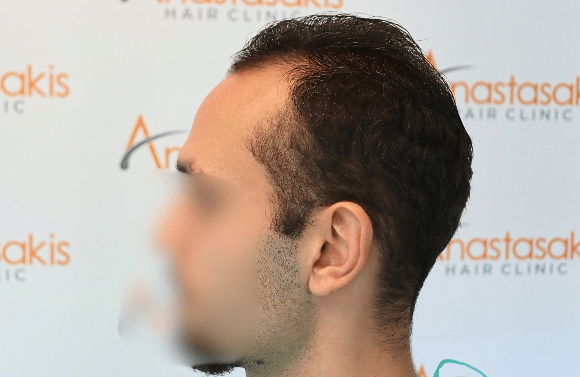 hair transplant result 2000 fus (4)