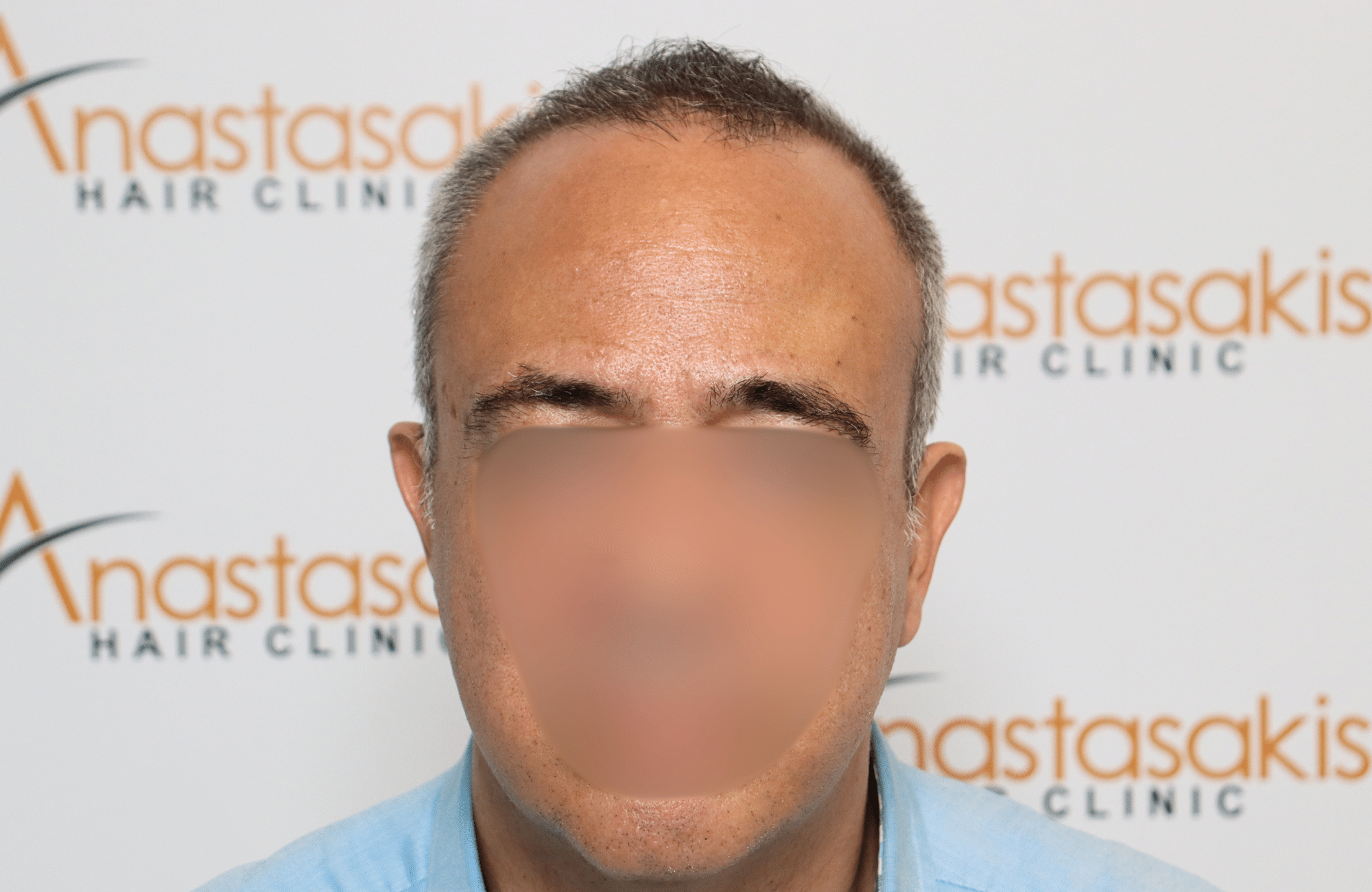 hair transplant result 2600 fus grey hair thin (1)