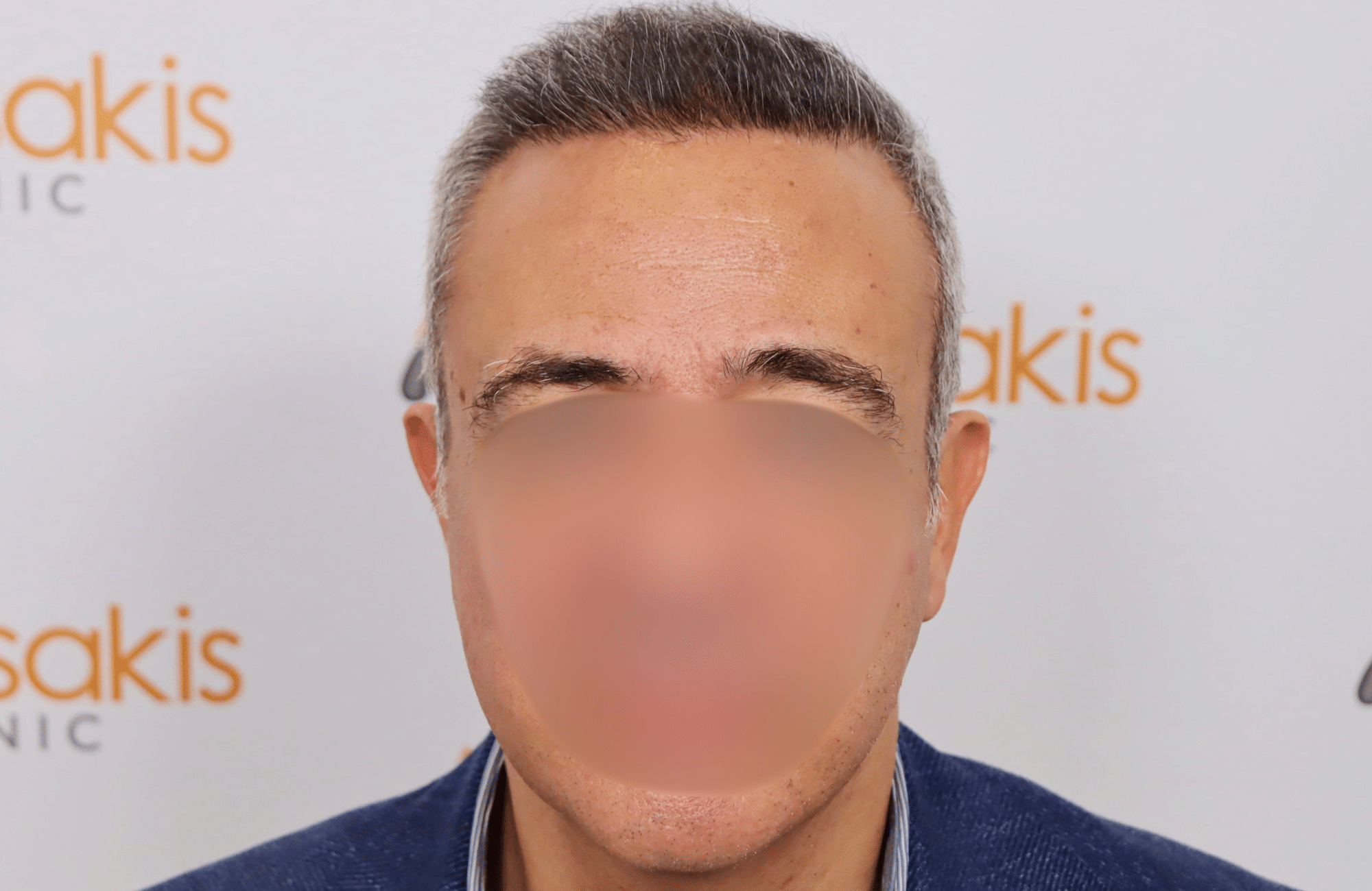 hair transplant result 2600 fus grey hair thin (2)