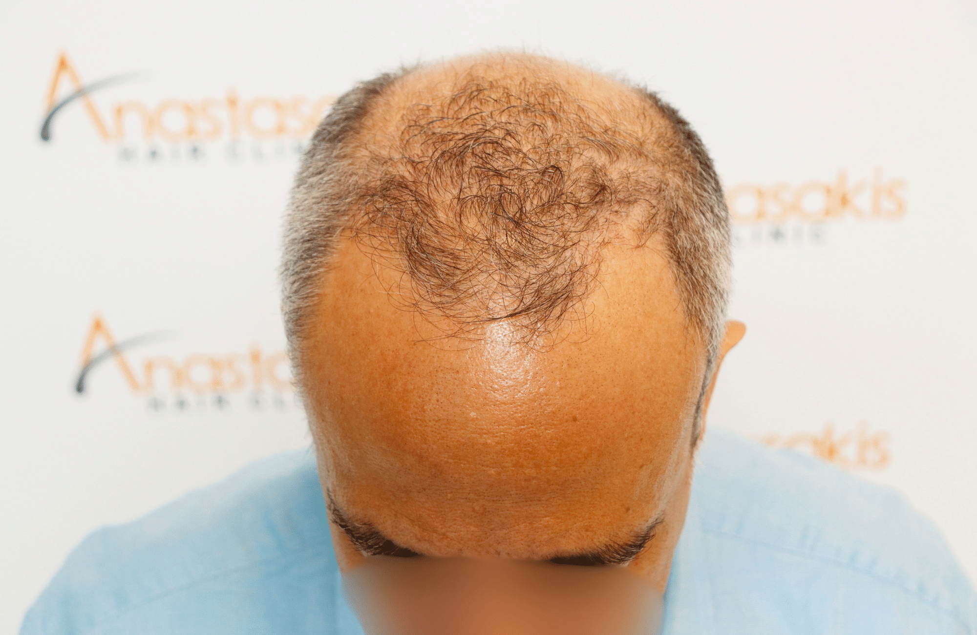 hair transplant result 2600 fus grey hair thin (2)
