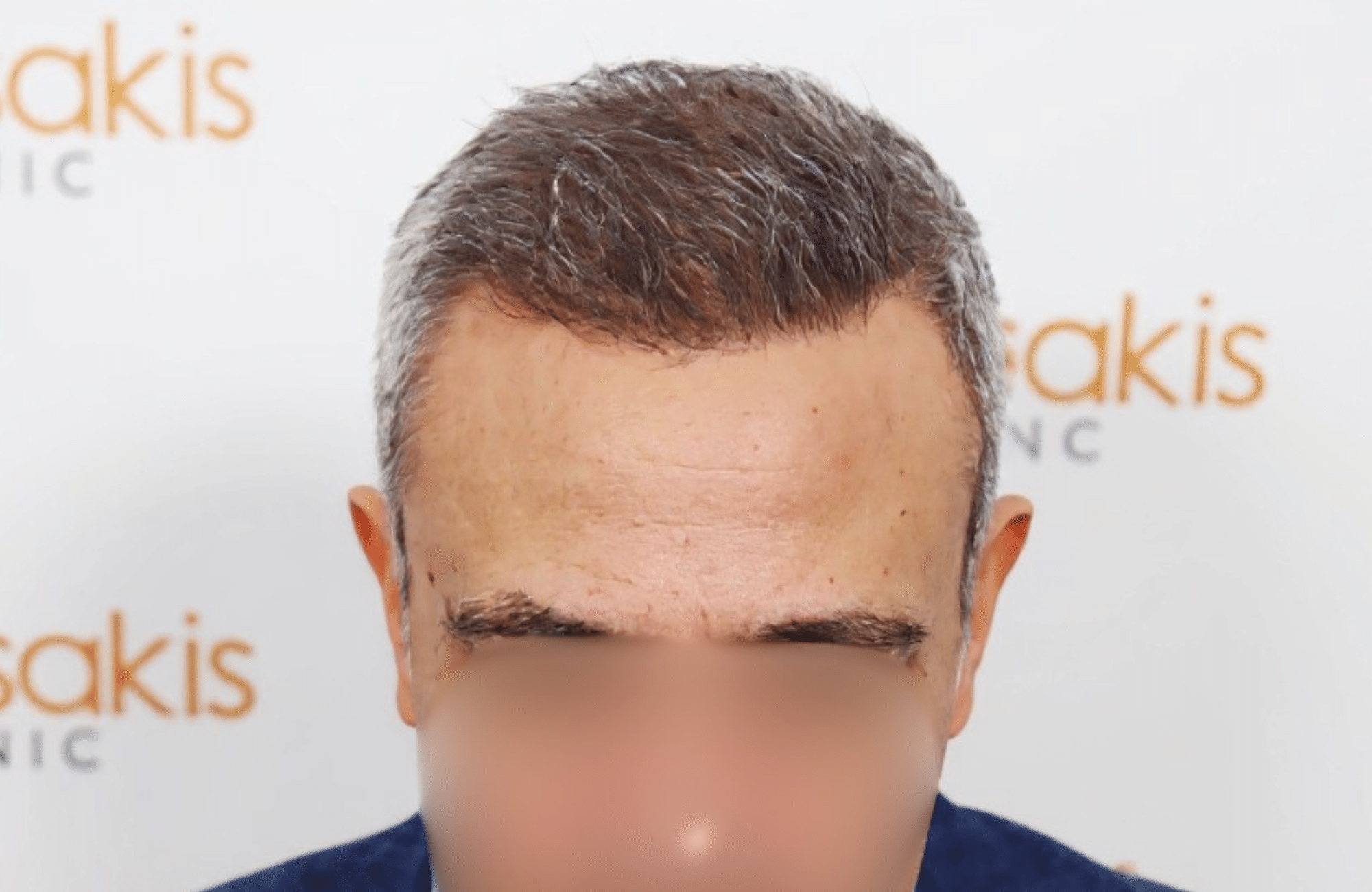 hair transplant result 2600 fus grey hair thin (4)