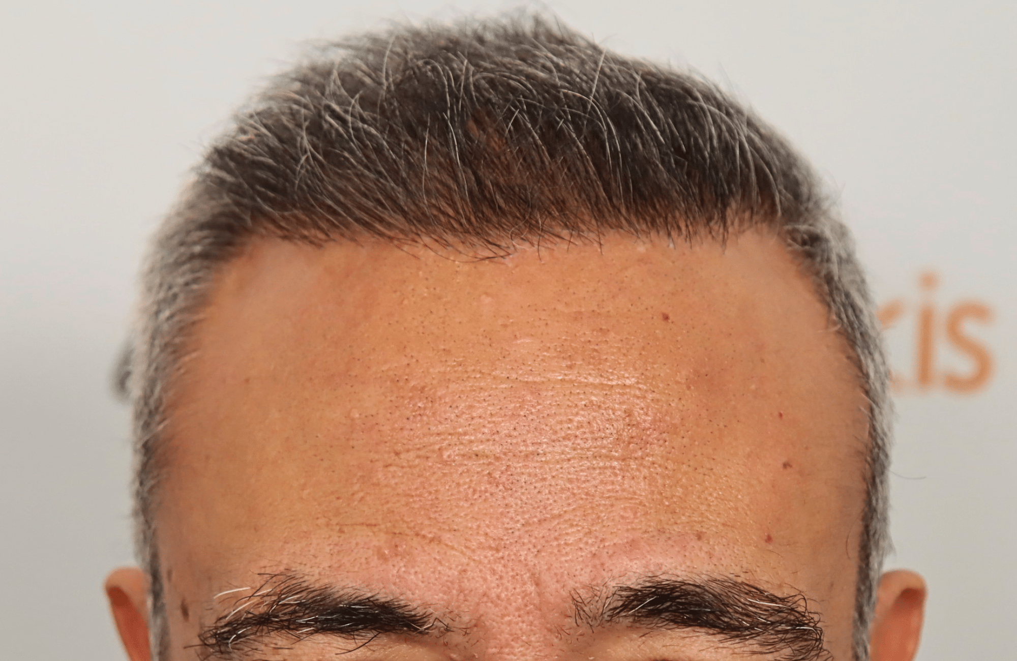hair transplant result 2600 fus grey hair thin (2)