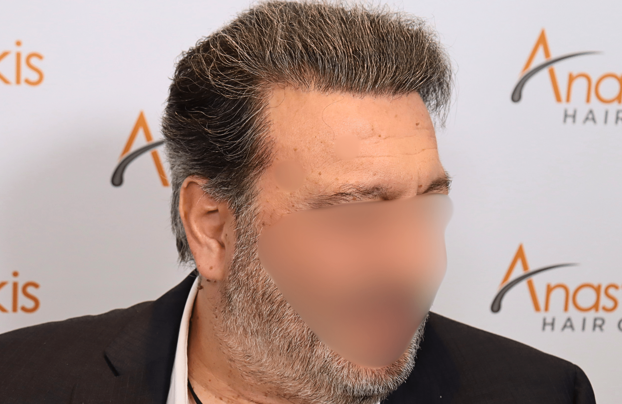 hair transplant result (3)