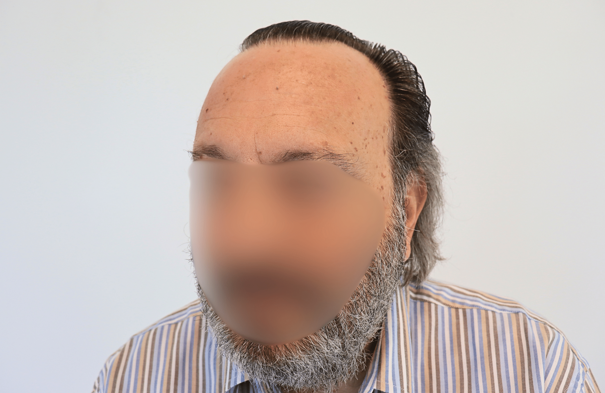 hair transplant result (4)