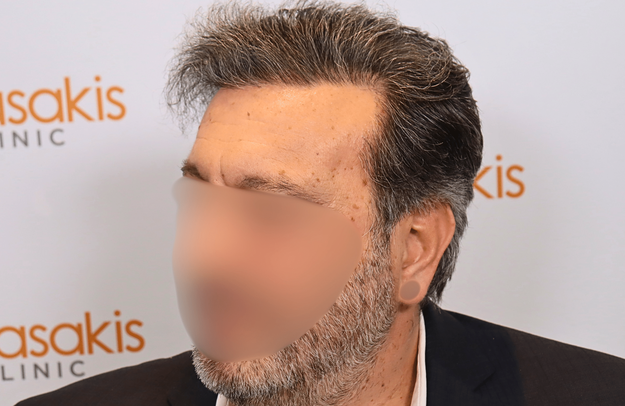 hair transplant result (5)