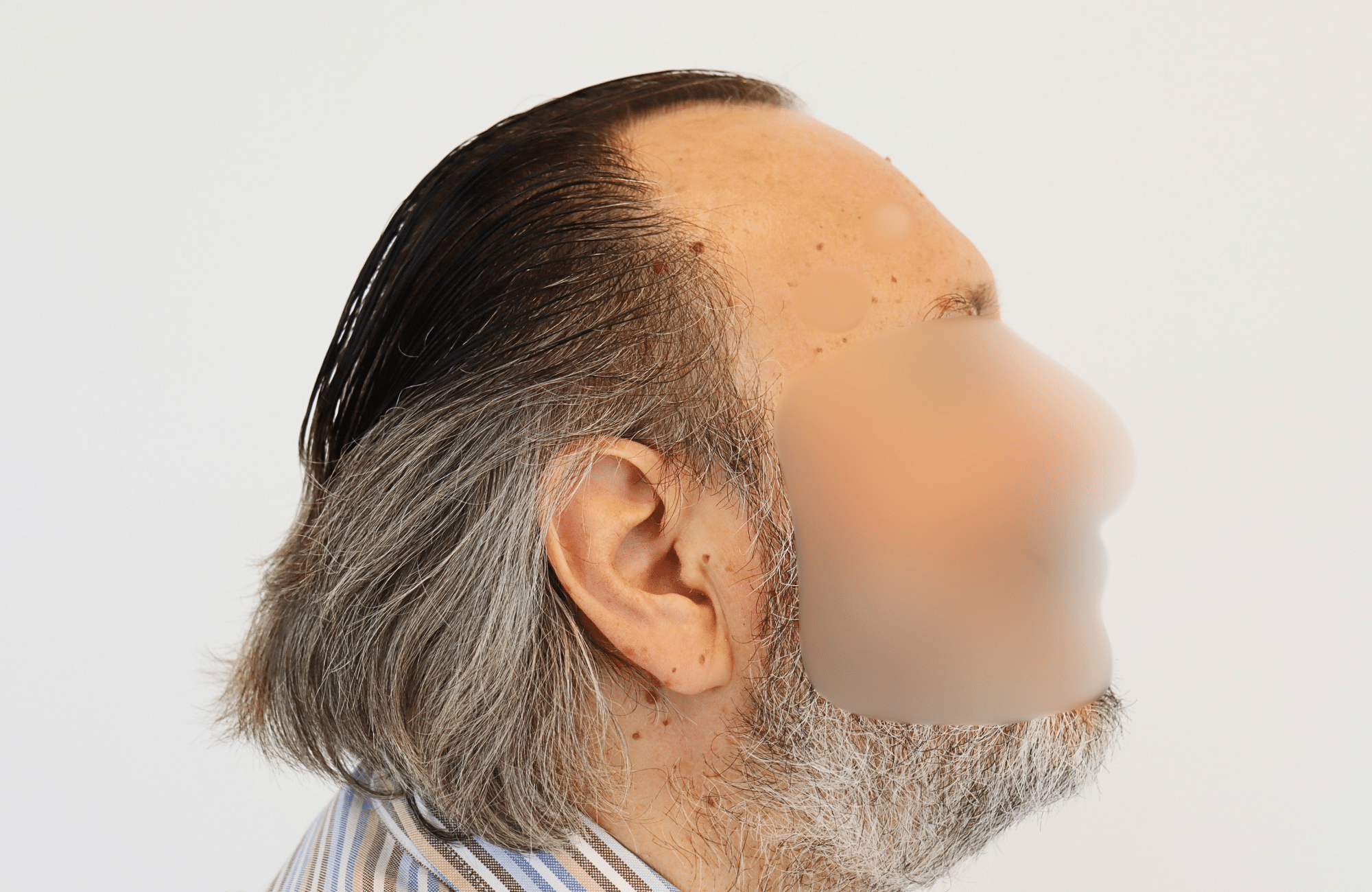 hair transplant result (6)