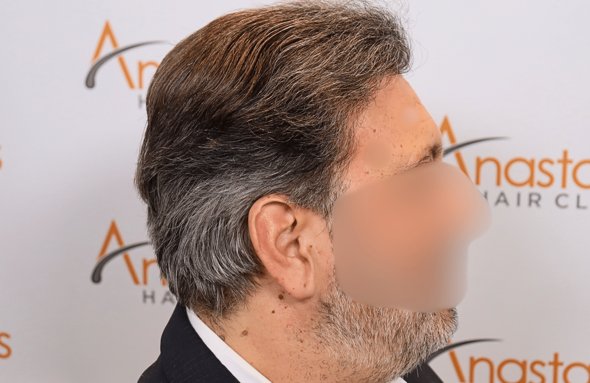 hair transplant result (7)
