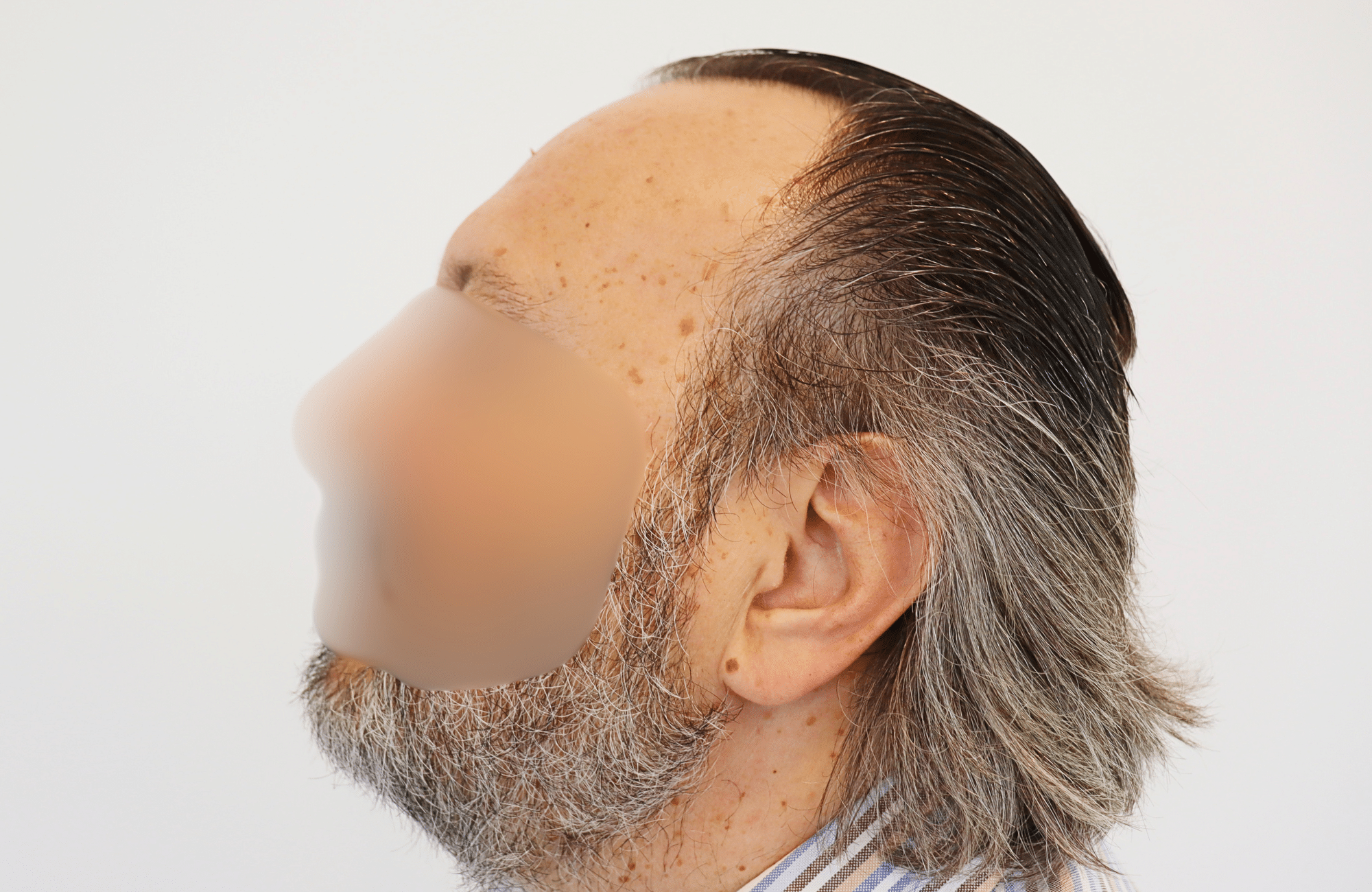 hair transplant result (8)