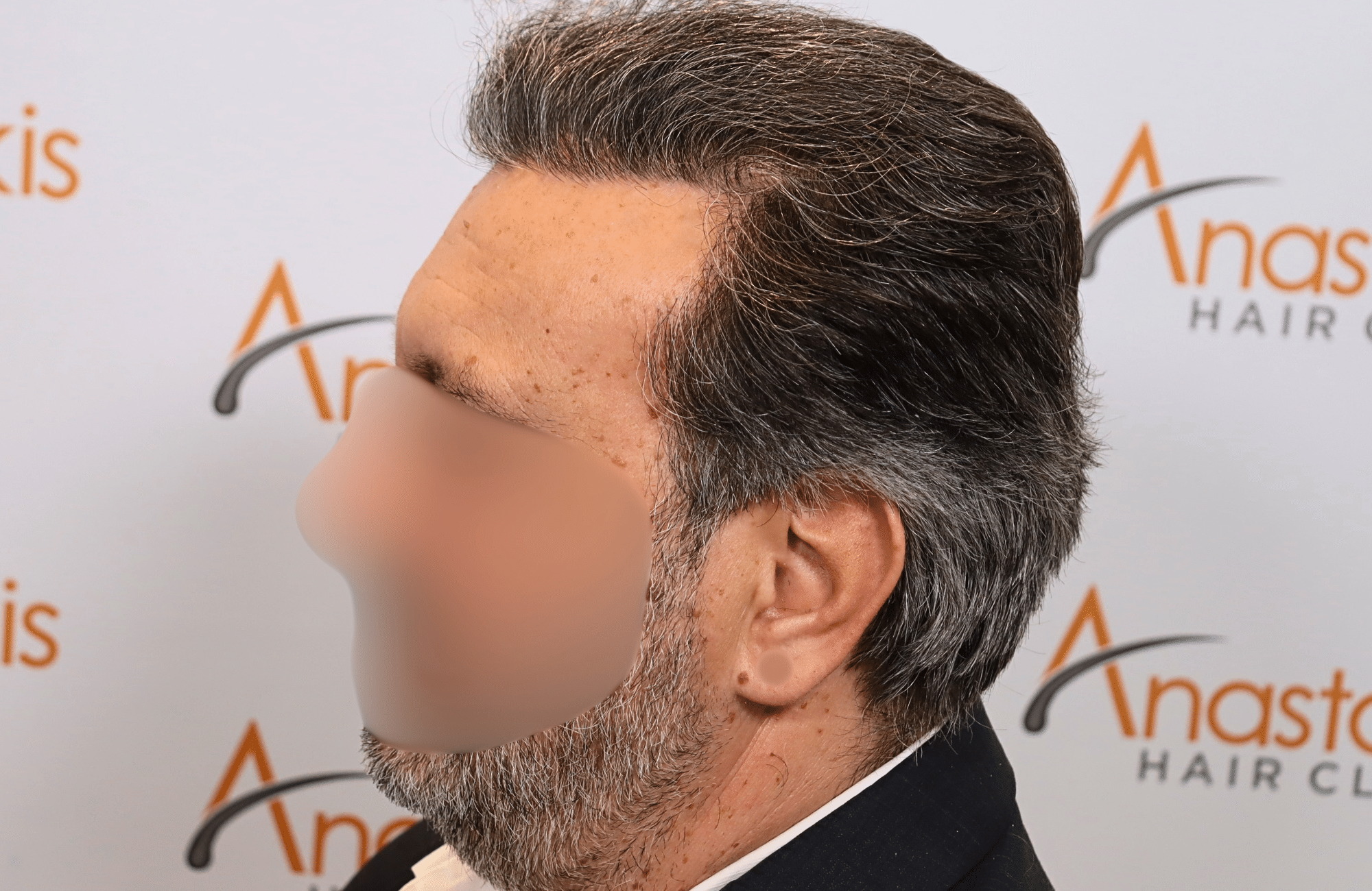 hair transplant result (9)