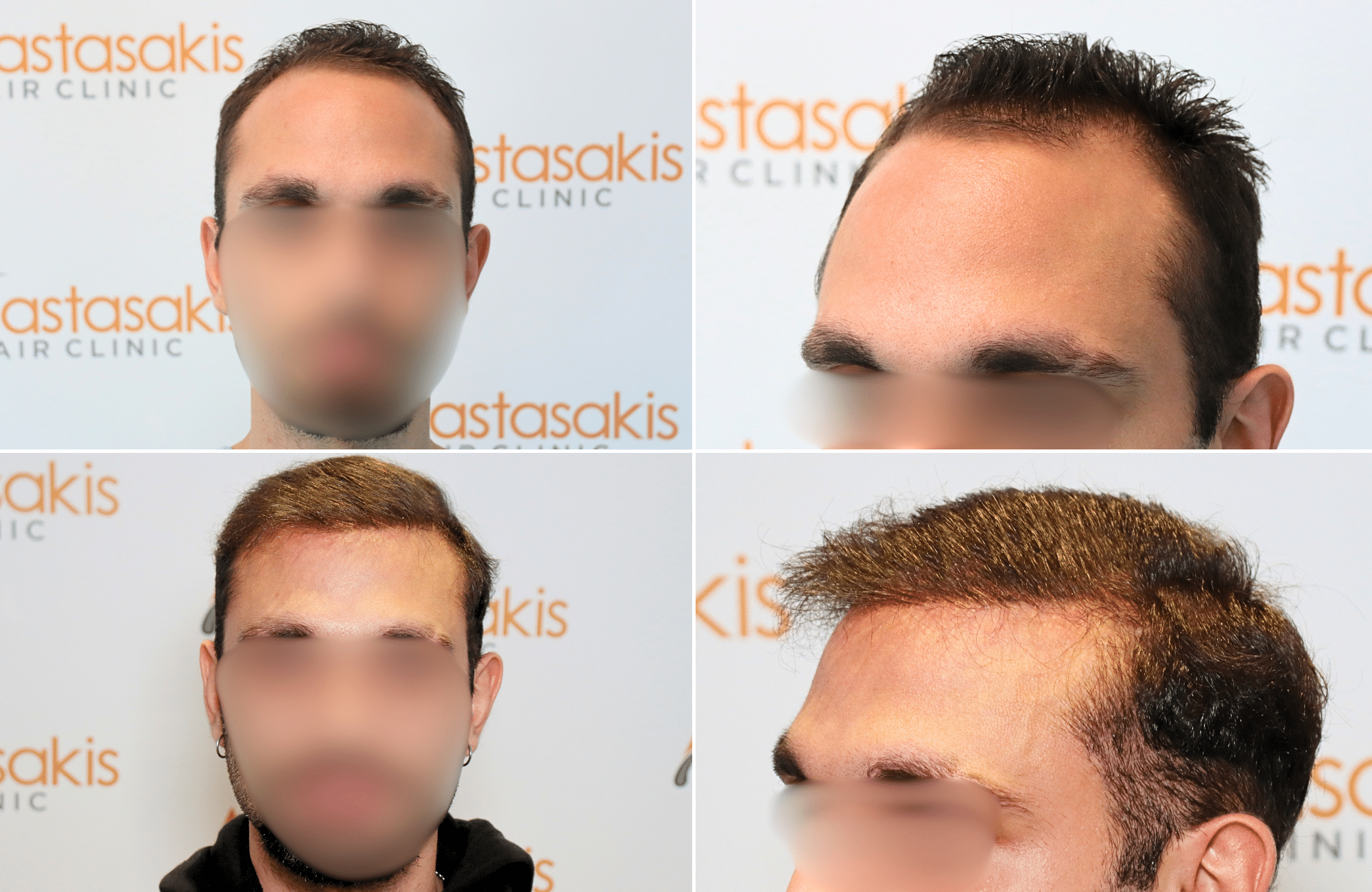 https://www.anastasakishairclinic.gr/portfolio/apotelesma-metamosxefsis-mallion-anastasakis-hair-clinic-224/