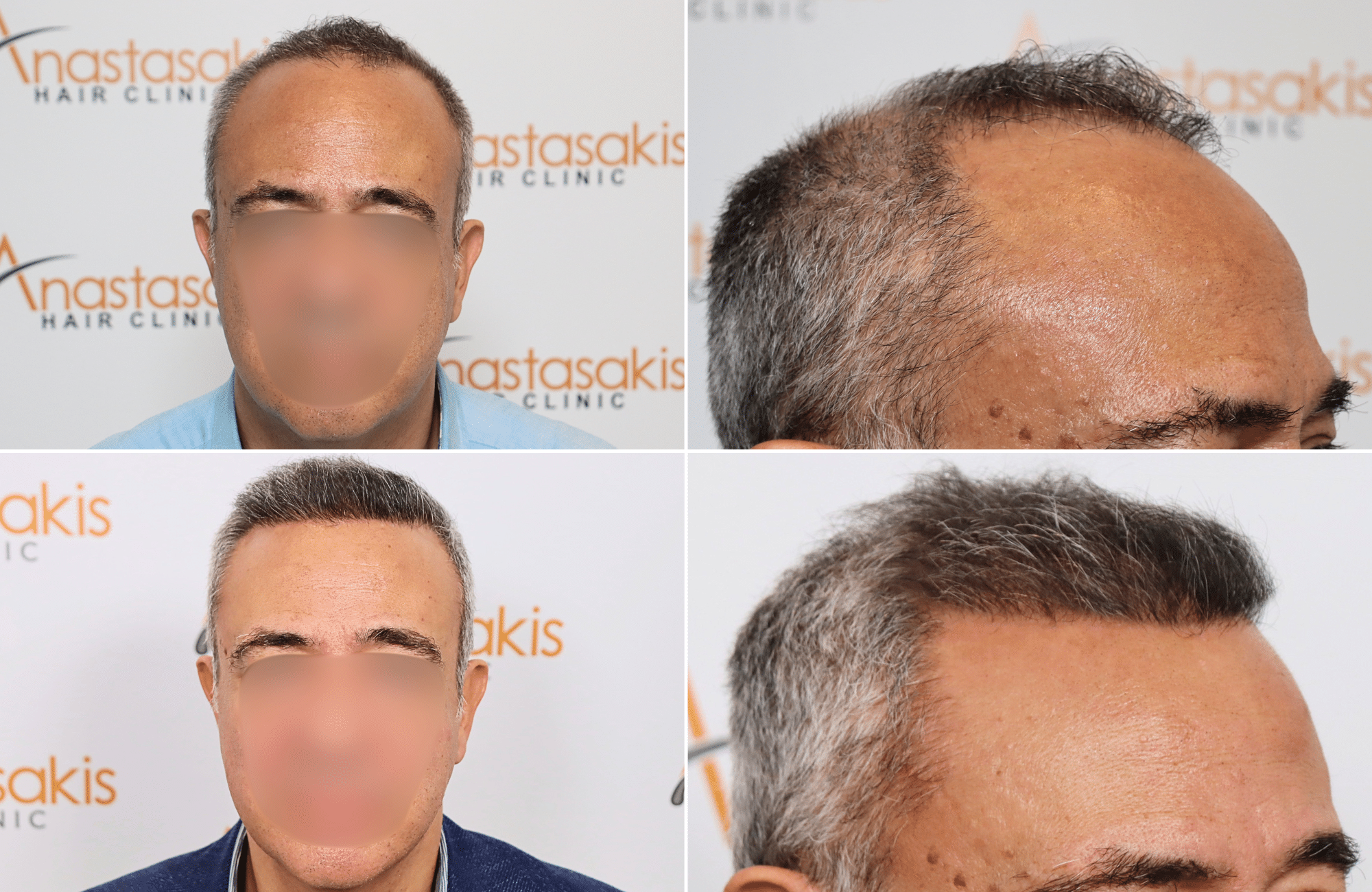 https://www.anastasakishairclinic.gr/portfolio/apotelesma-metamosxefsis-mallion-anastasakis-hair-clinic-601/