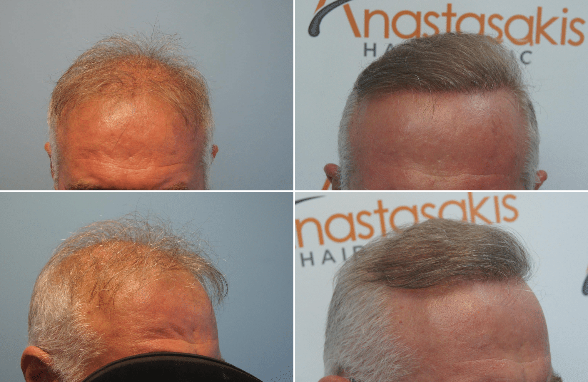https://www.anastasakishairclinic.gr/portfolio/apotelesma-metamosxefsis-mallion-anastasakis-hair-clinic-242/