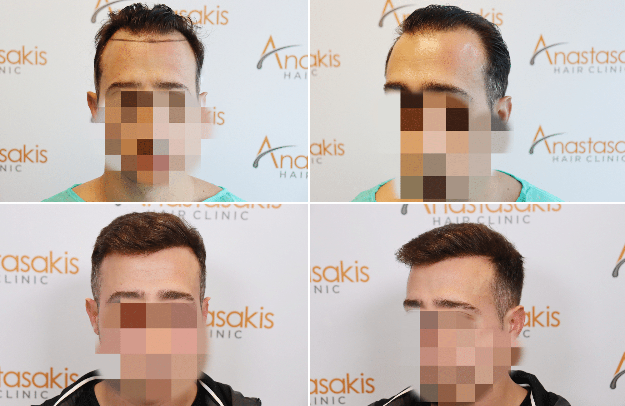 https://www.anastasakishairclinic.gr/portfolio/apotelesma-metamosxefsis-mallion-anastasakis-hair-clinic-252/