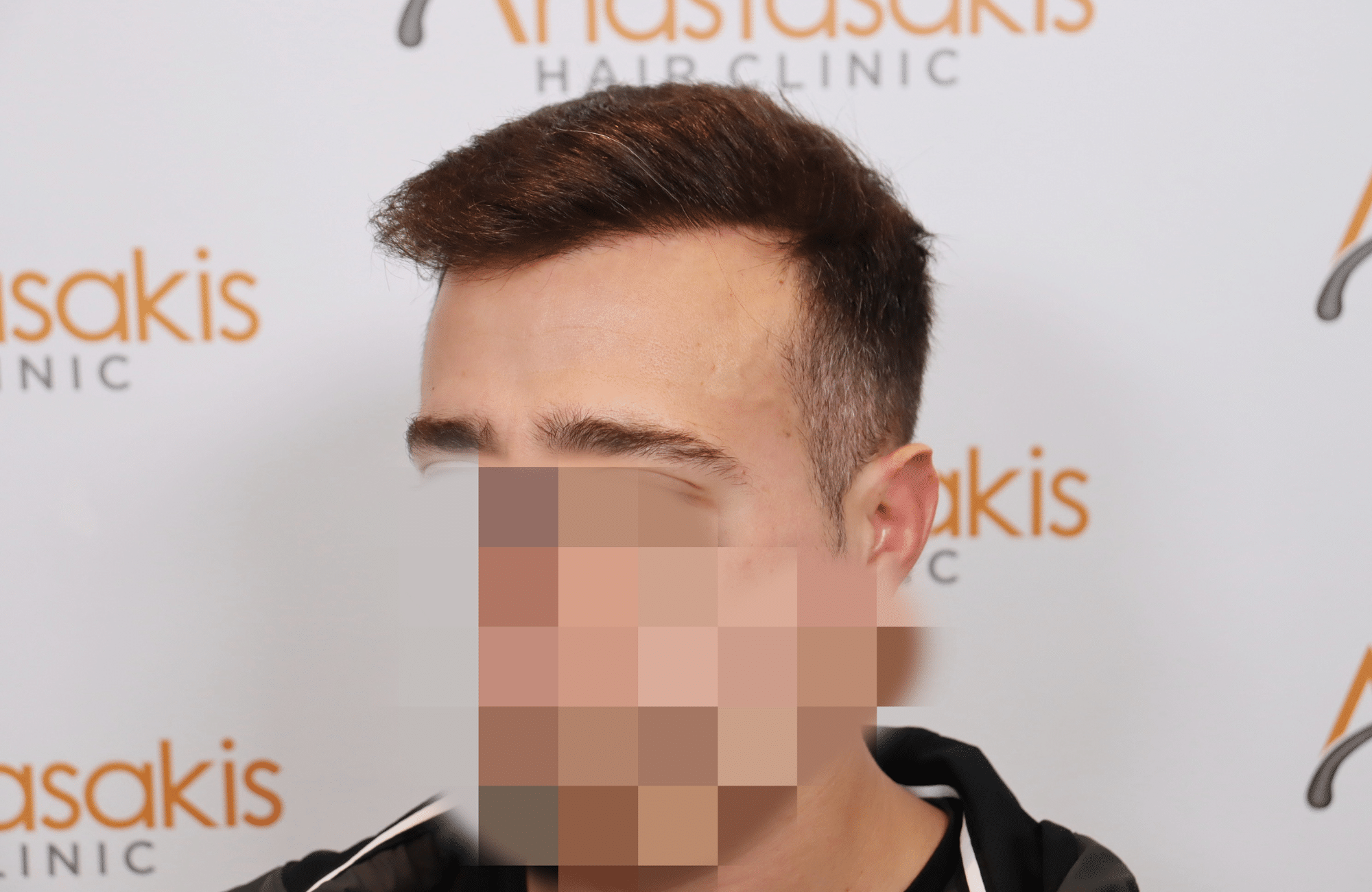 hair transplant result (10)