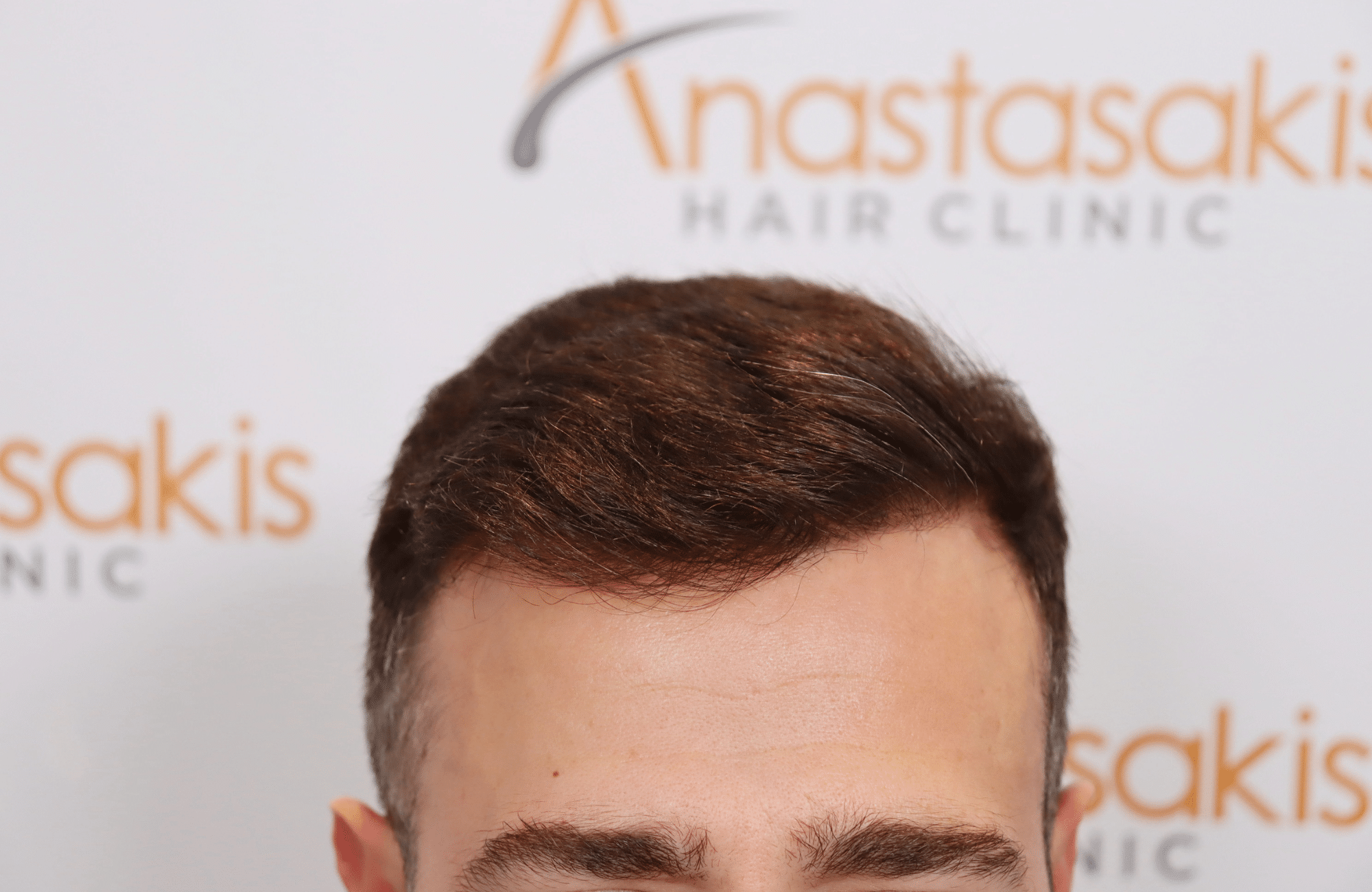 hair transplant result (11)
