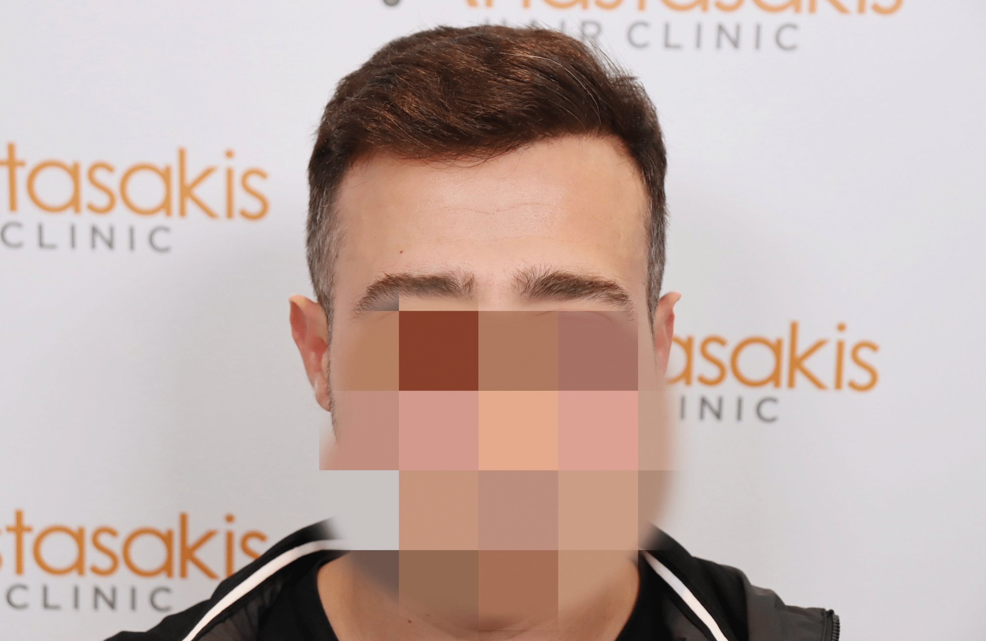 hair transplant result (12)