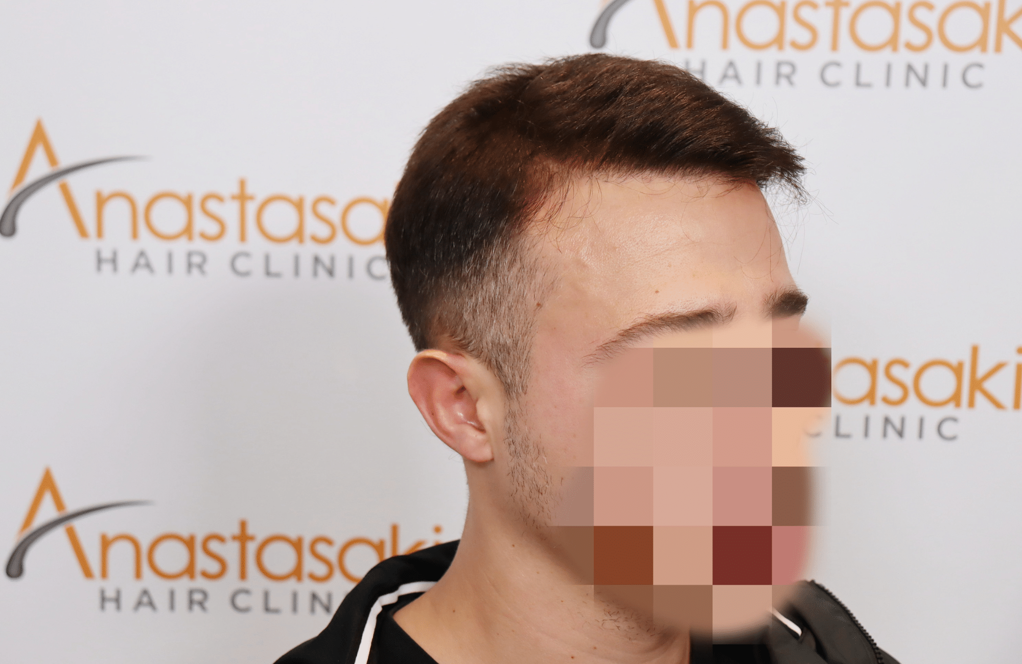hair transplant result (9)