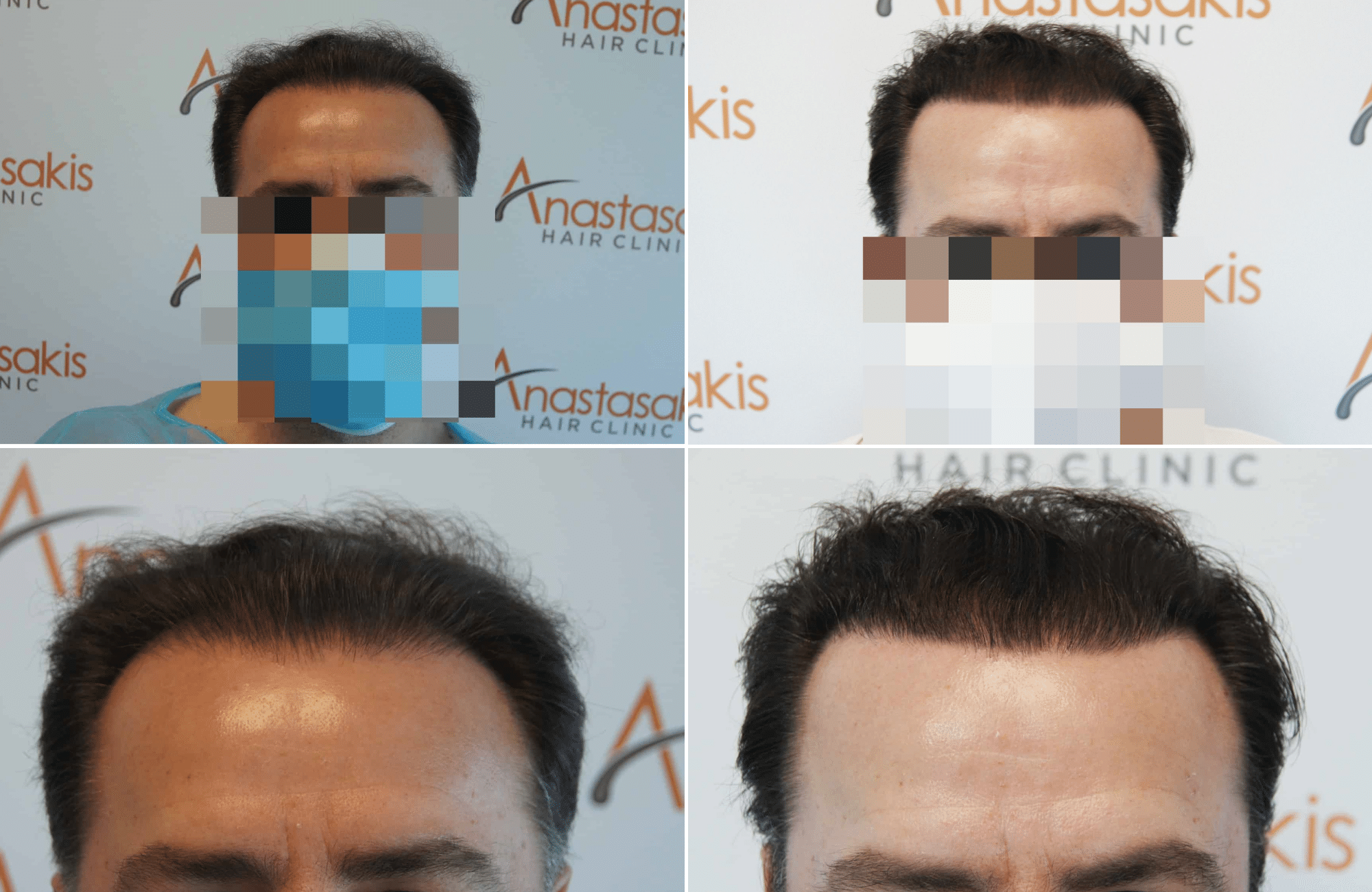 https://www.anastasakishairclinic.gr/portfolio/apotelesma-metamosxefsis-mallion-anastasakis-hair-clinic-325/