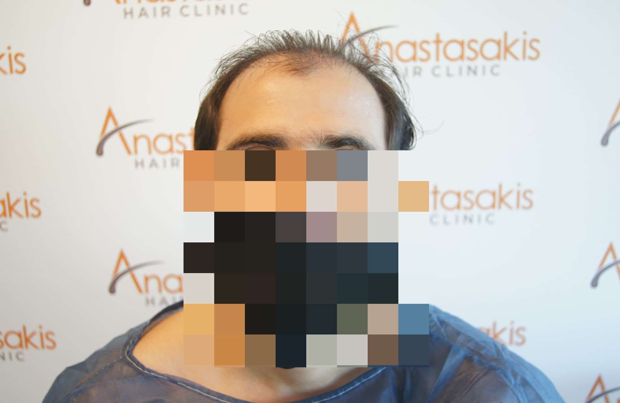 περιστατικο anastasakis hair clinic πριν τη μεταμοσχευση μαλλιων με fue - fullface