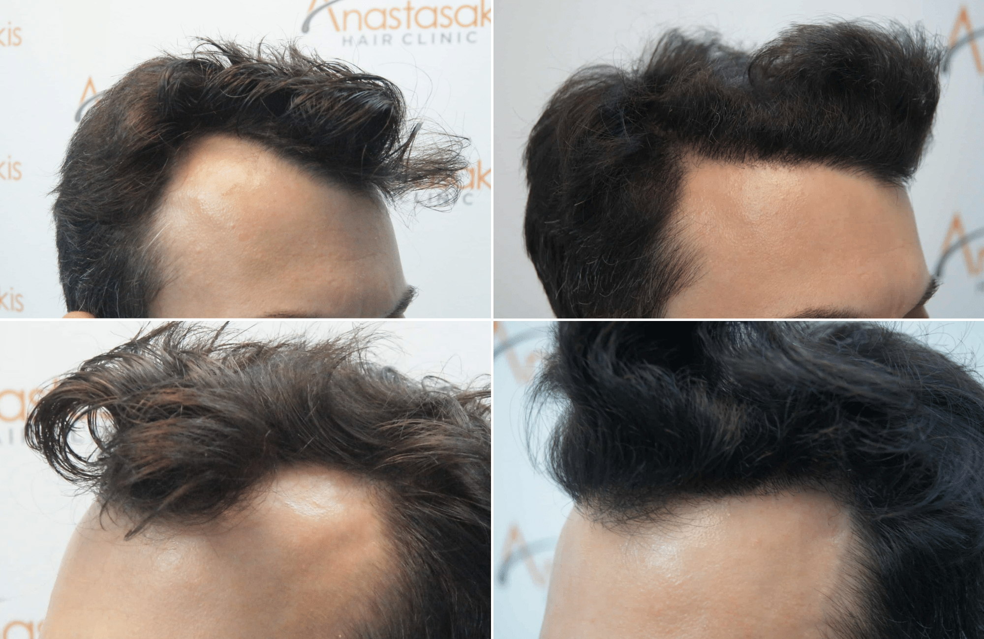 https://www.anastasakishairclinic.gr/portfolio/apotelesma-metamosxefsis-mallion-anastasakis-hair-clinic-10/
