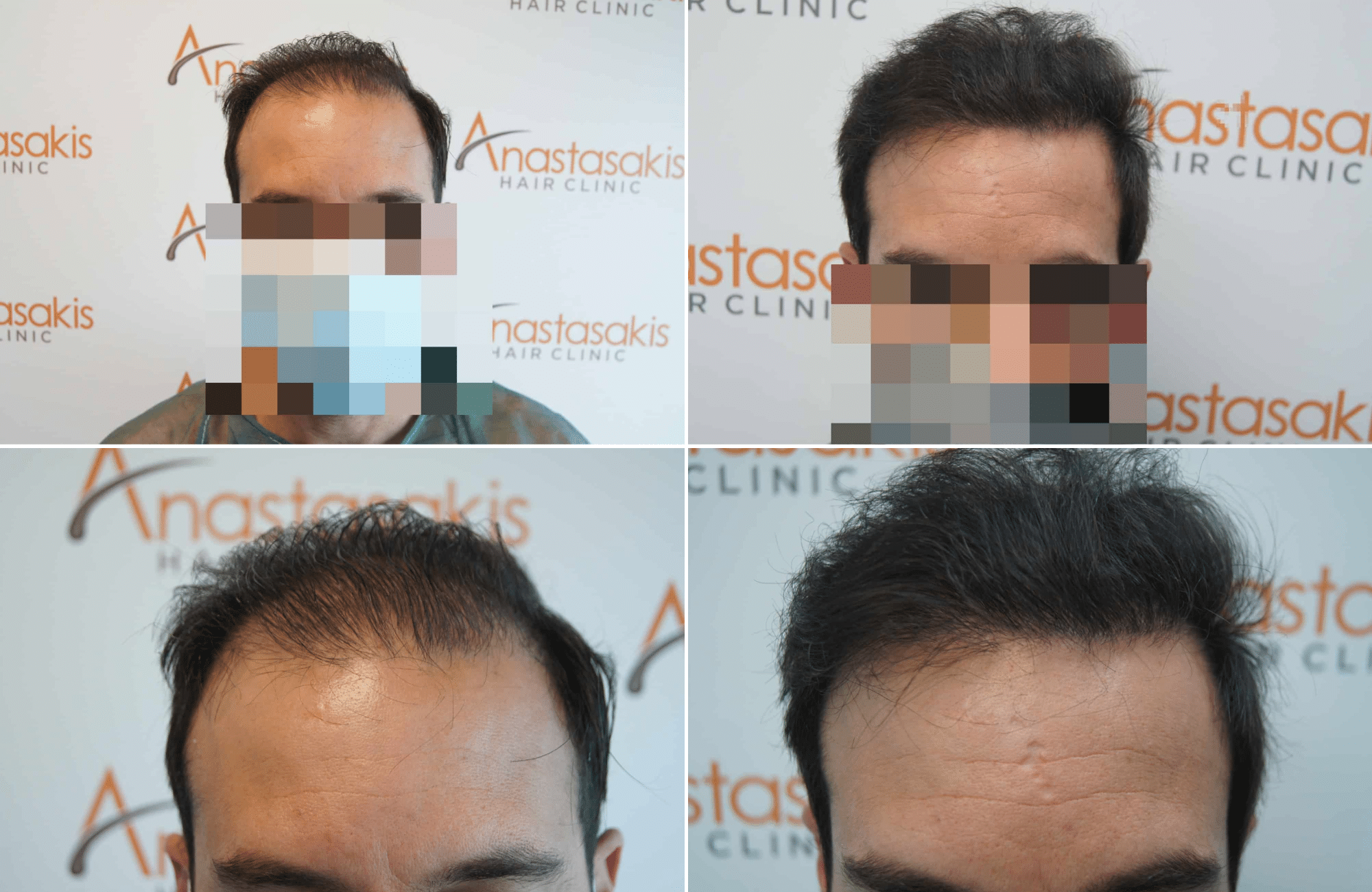 https://www.anastasakishairclinic.gr/portfolio/apotelesma-metamosxefsis-mallion-anastasakis-hair-clinic-11/