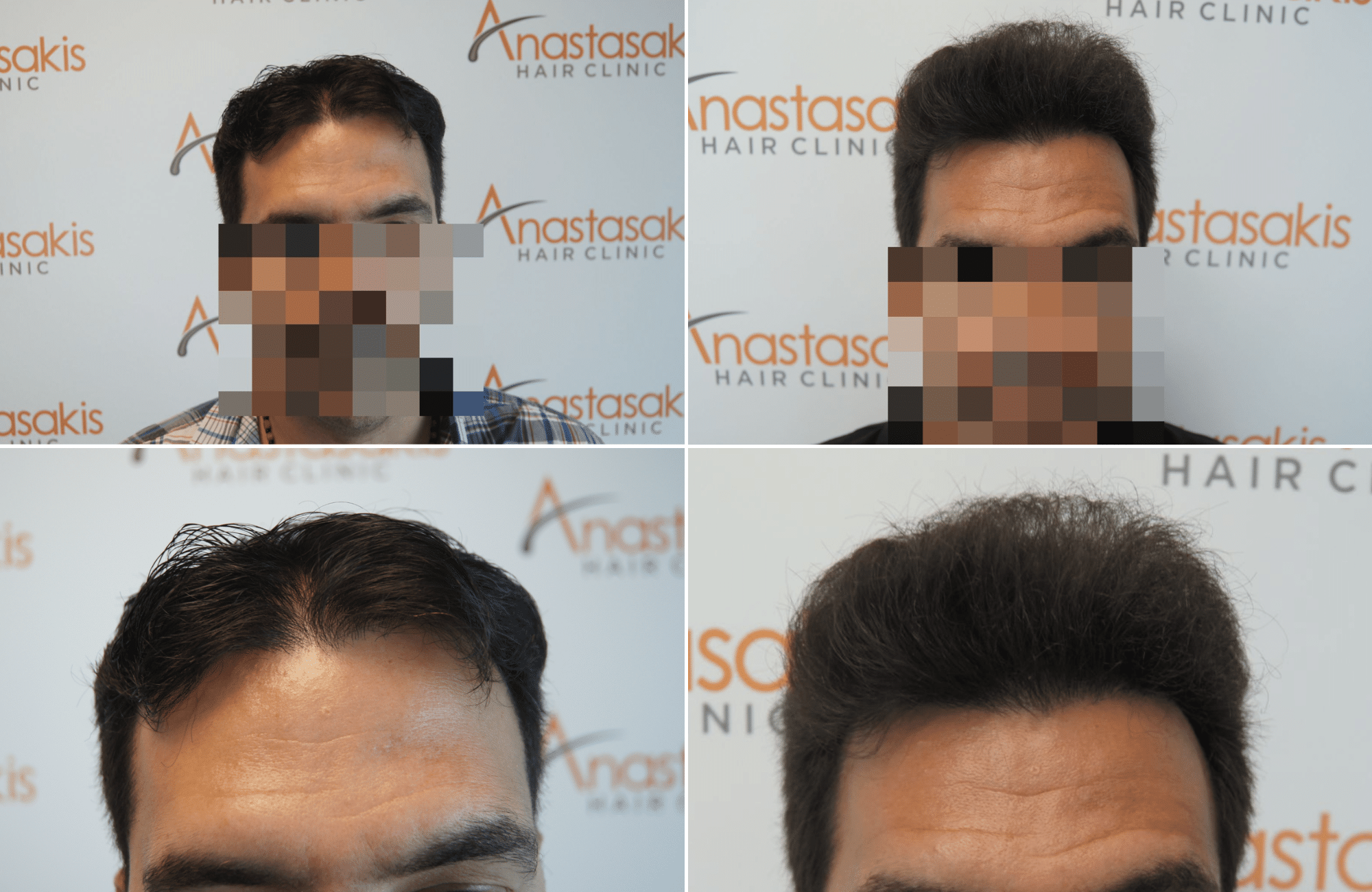 https://www.anastasakishairclinic.gr/portfolio/apotelesma-metamosxefsis-mallion-anastasakis-hair-clinic-16/