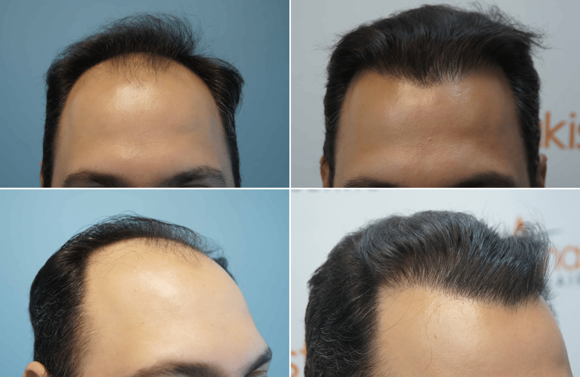 https://www.anastasakishairclinic.gr/portfolio/apotelesma-metamosxefsis-mallion-anastasakis-hair-clinic-202/