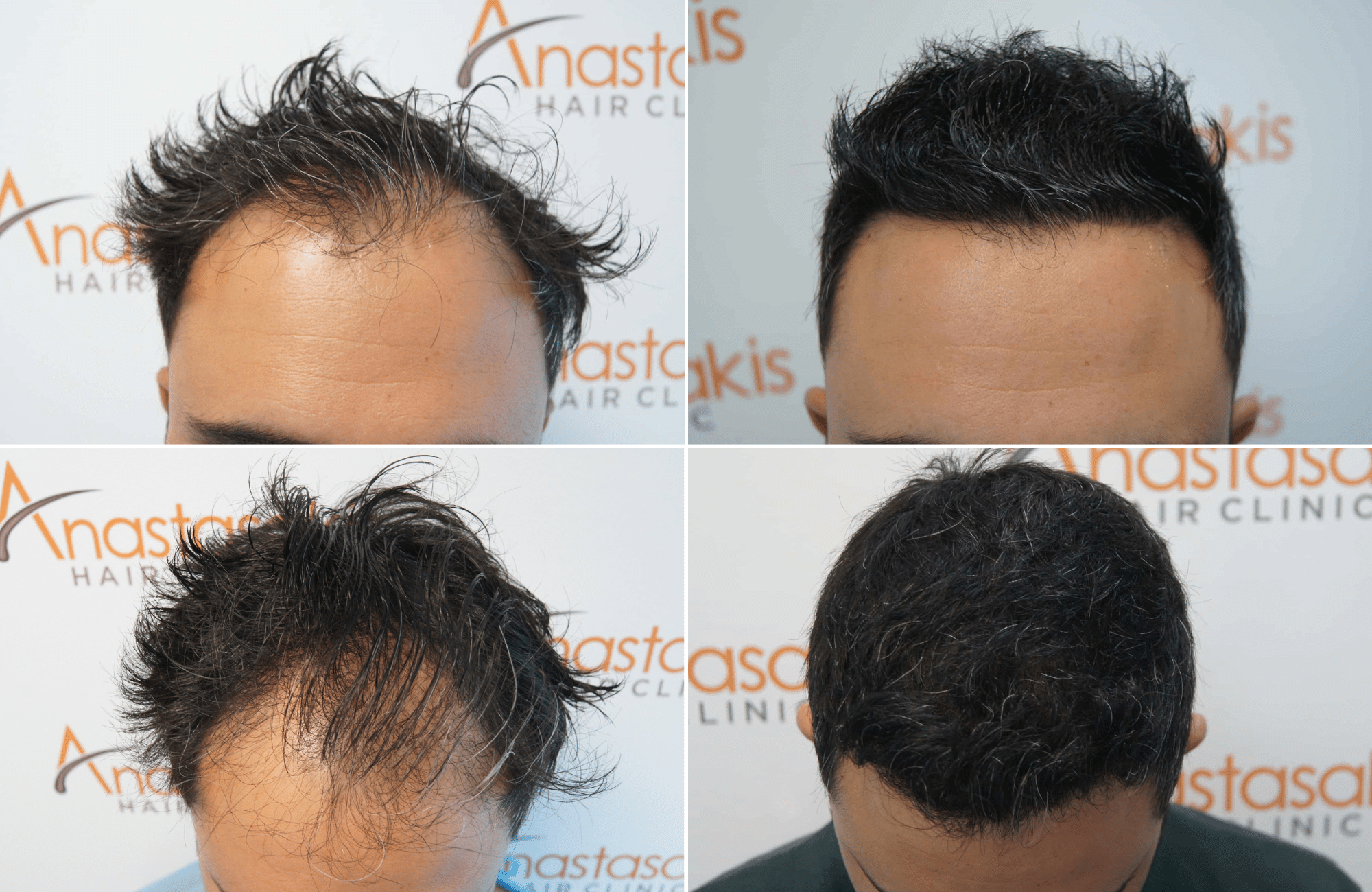https://www.anastasakishairclinic.gr/portfolio/apotelesma-2300fus-fue-ahc/