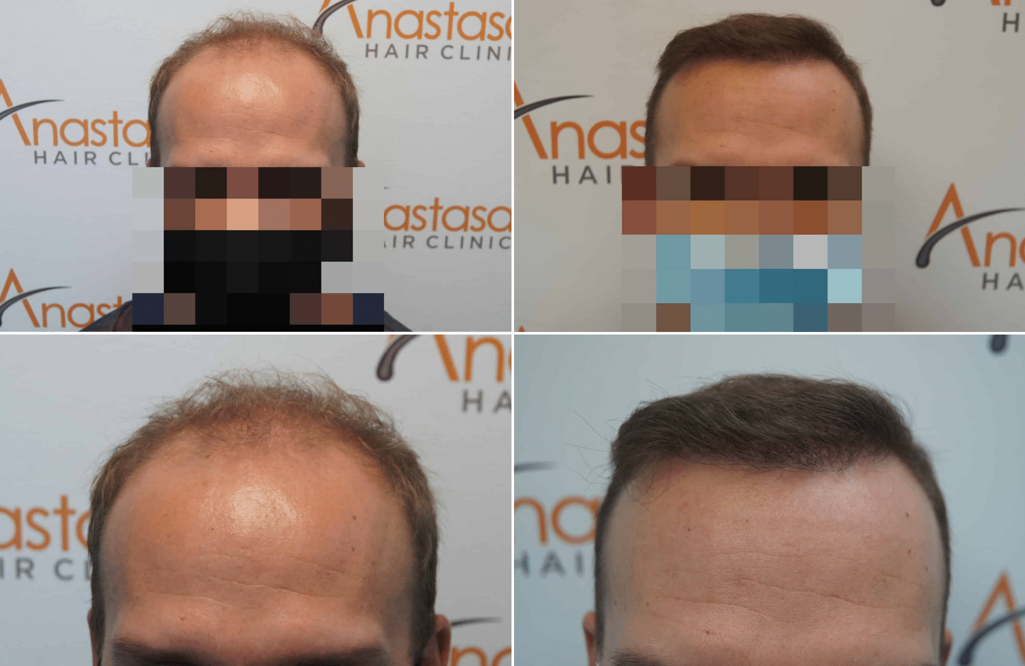https://www.anastasakishairclinic.gr/portfolio/apotelesma-metamosxefsis-mallion-anastasakis-hair-clinic-6/
