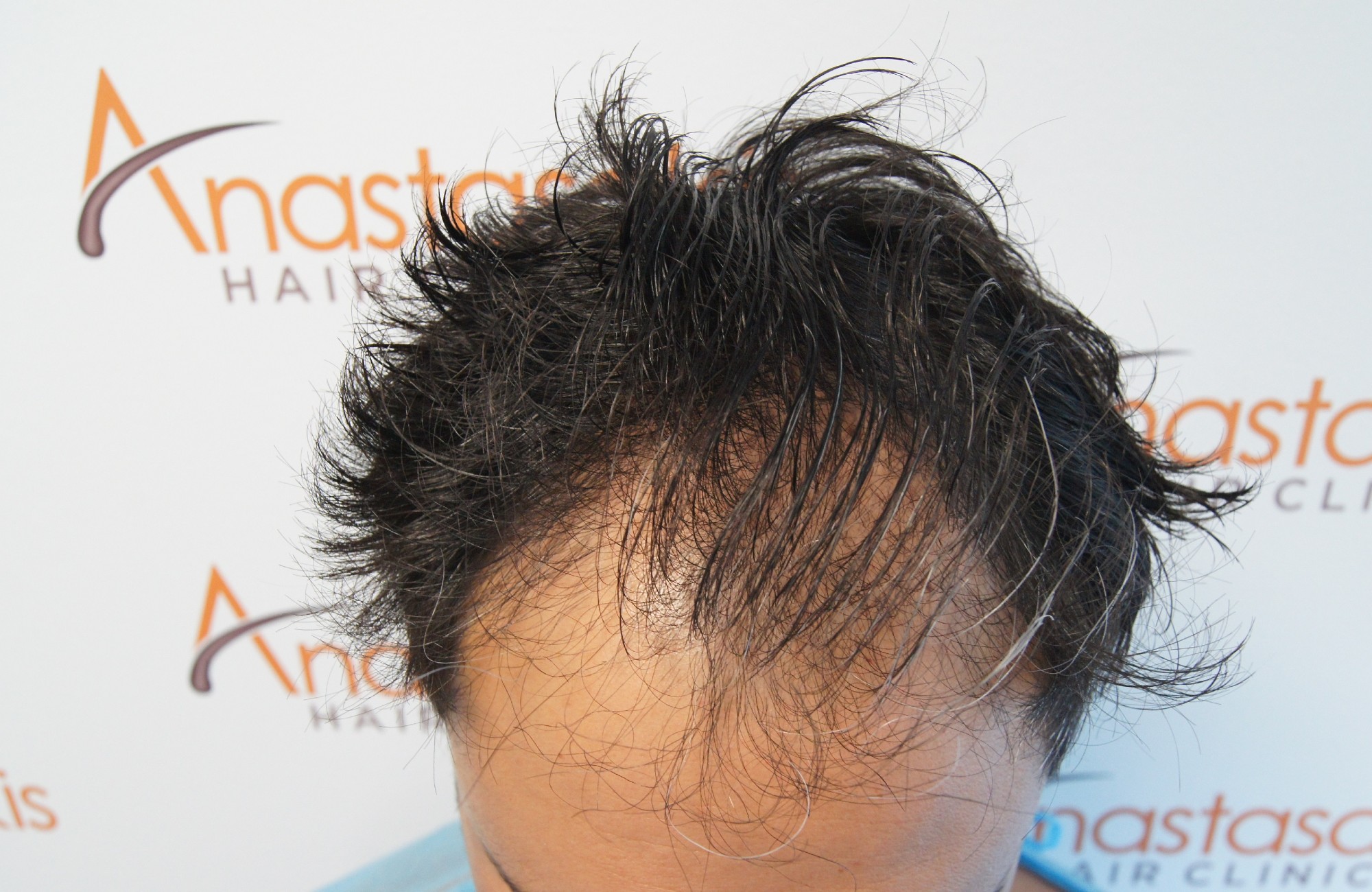 anastasakis hair clinic - περιστατικο πριν τη μεταμοσχευση μαλλιων του με fue