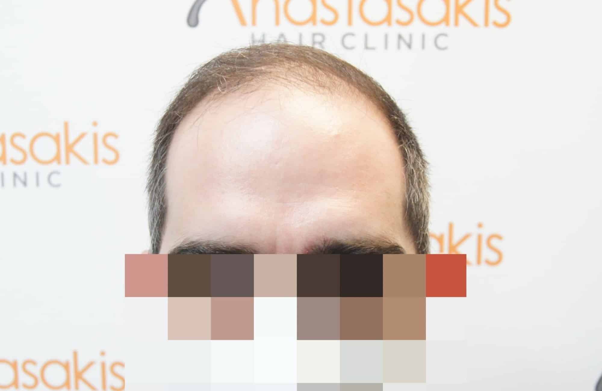 περιστατικό πριν τη μεταμοσχευση μαλλιων με 3200 fus