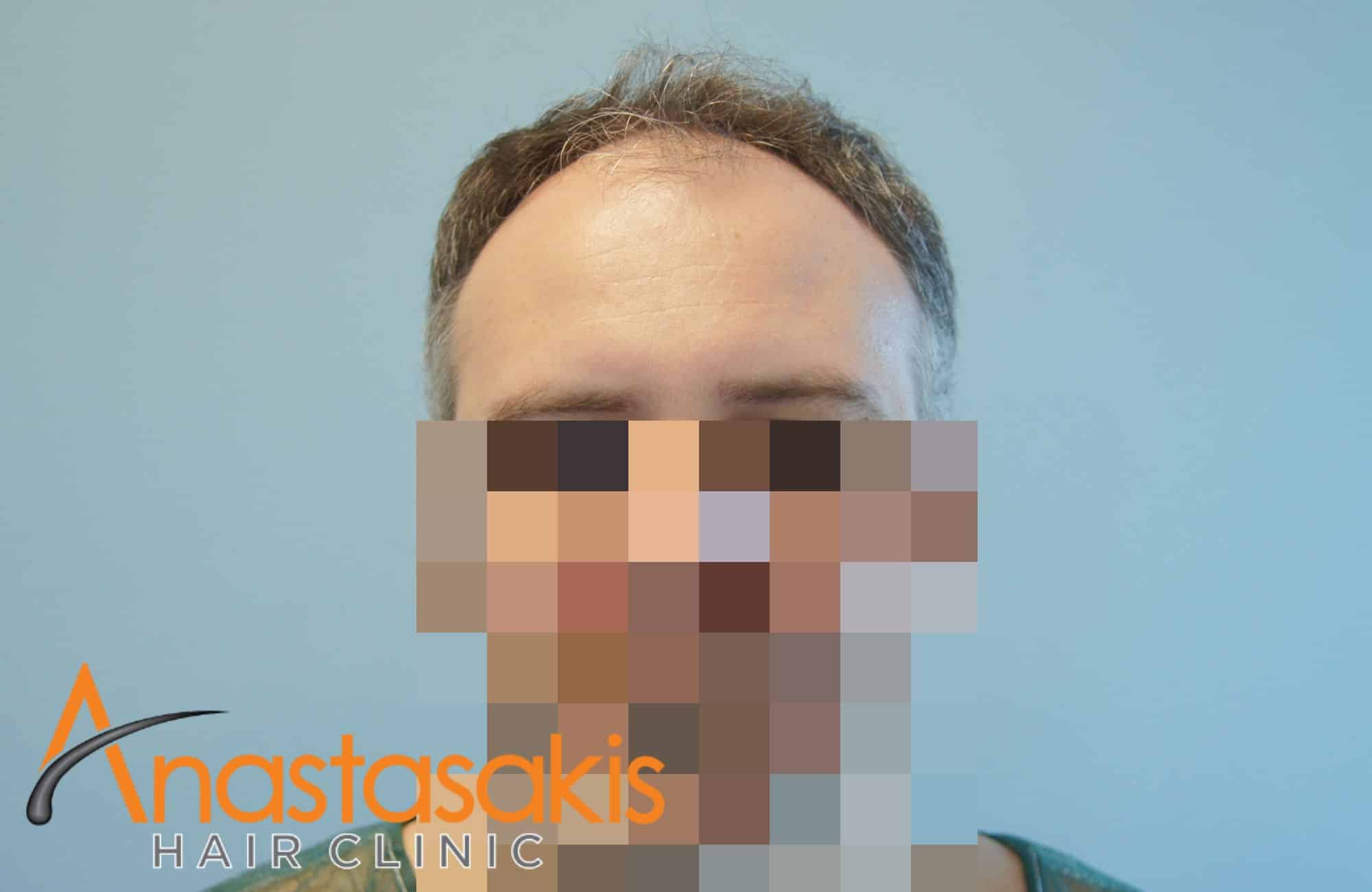 fullface περιστατικου πριν τη μεταμοσχευση με fut - 2500 τριχοθυλακια