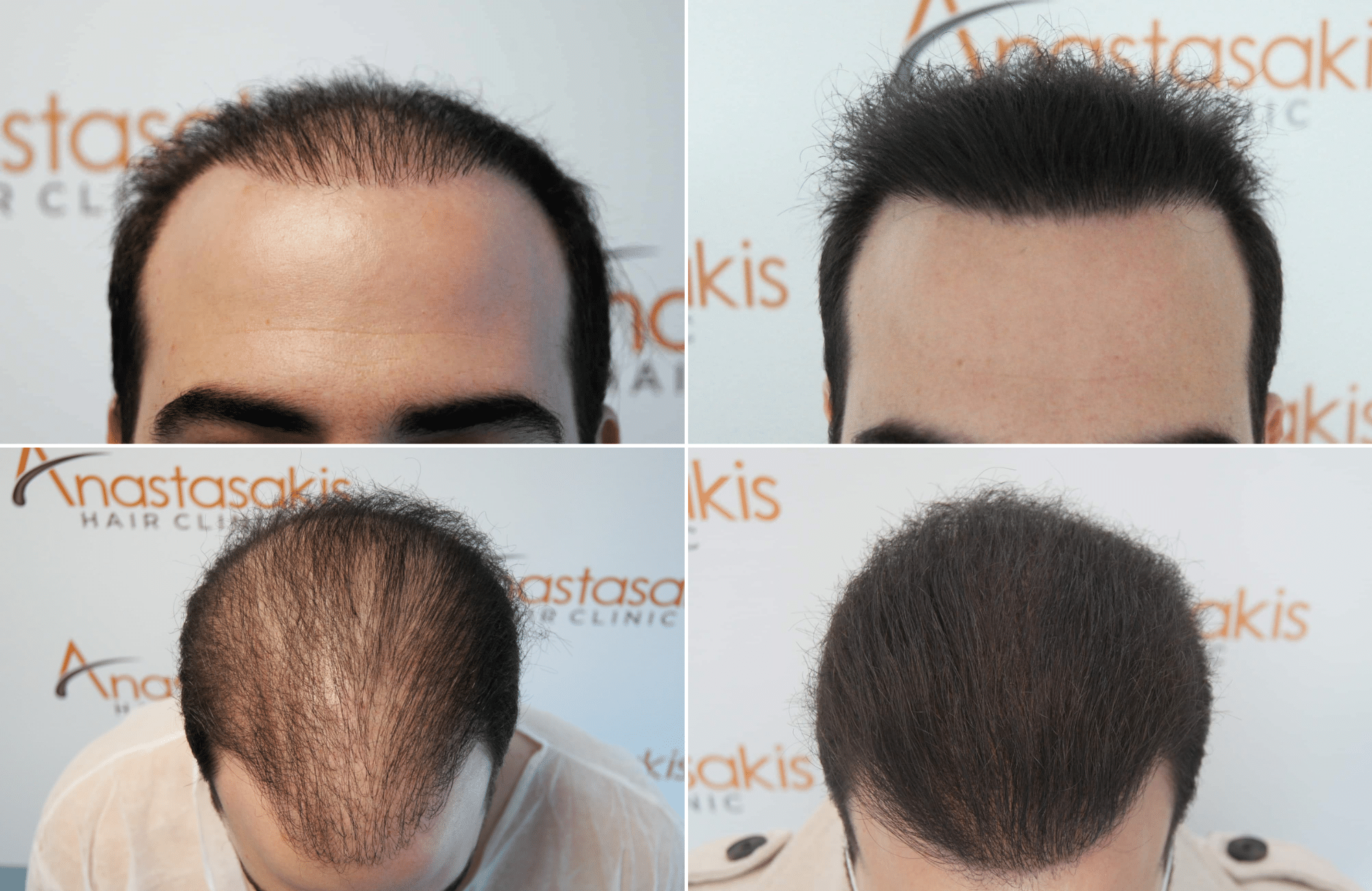 https://www.anastasakishairclinic.gr/portfolio/apotelesma-metamosxefsis-me-combo-3500fus/