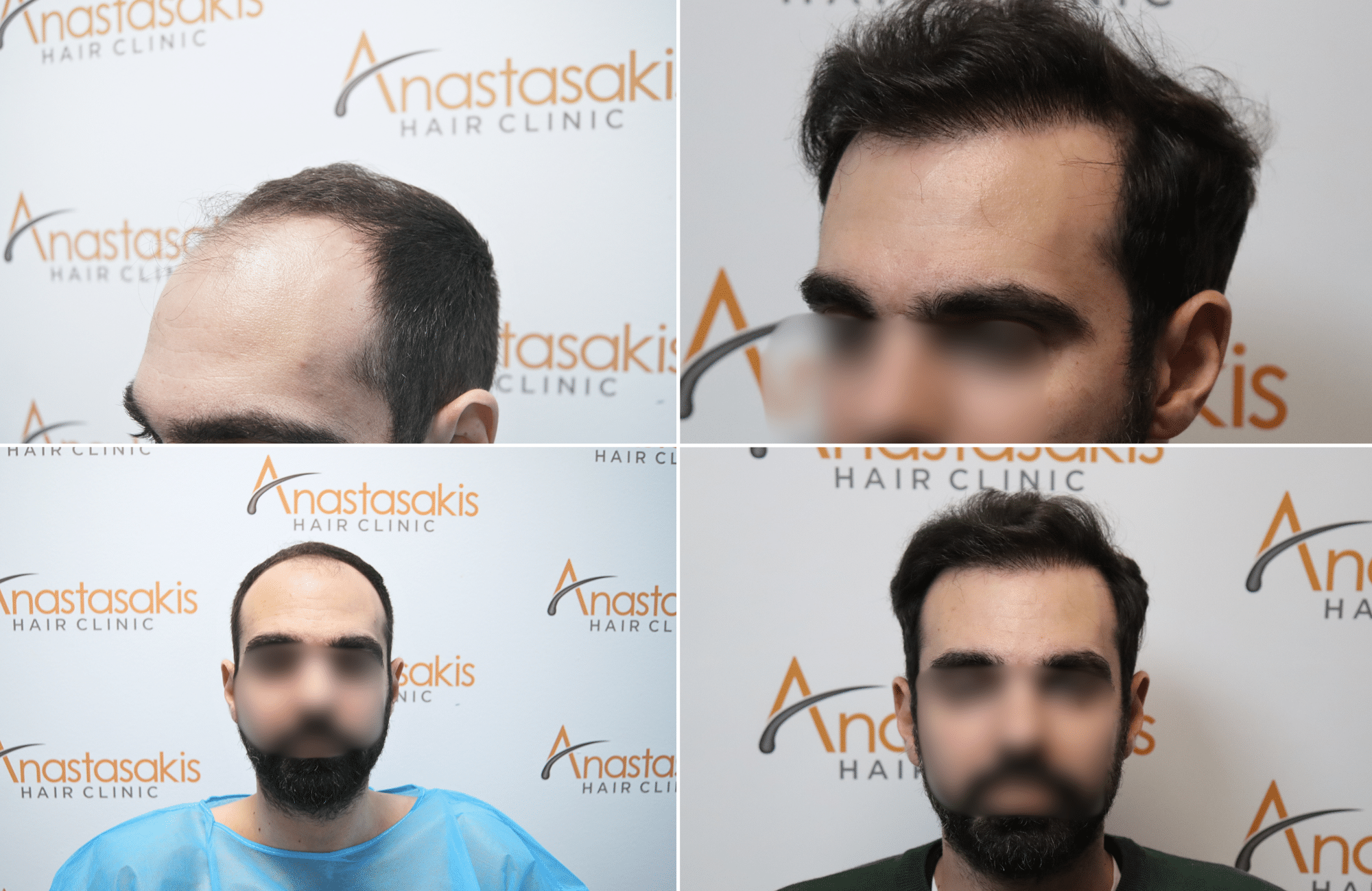 https://www.anastasakishairclinic.gr/portfolio/apotelesma-metamosxefsis-mallion-anastasakis-hair-clinic-5/