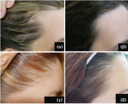 μεταμόσχευση μαλλιών στις γυναίκες αποτέλεσμα