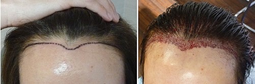μεταμόσχευση μαλλιών στις γυναίκες διαδικασία