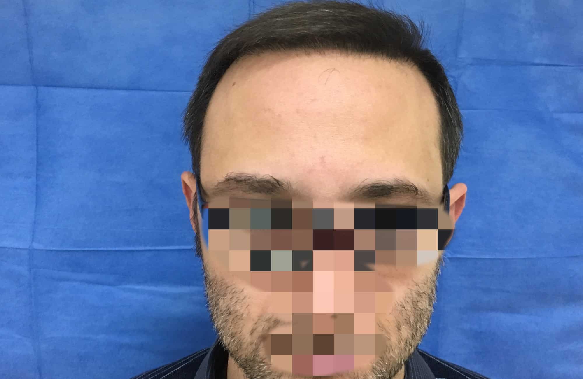 μεταμοσχευση μαλλιων πριν και μετα