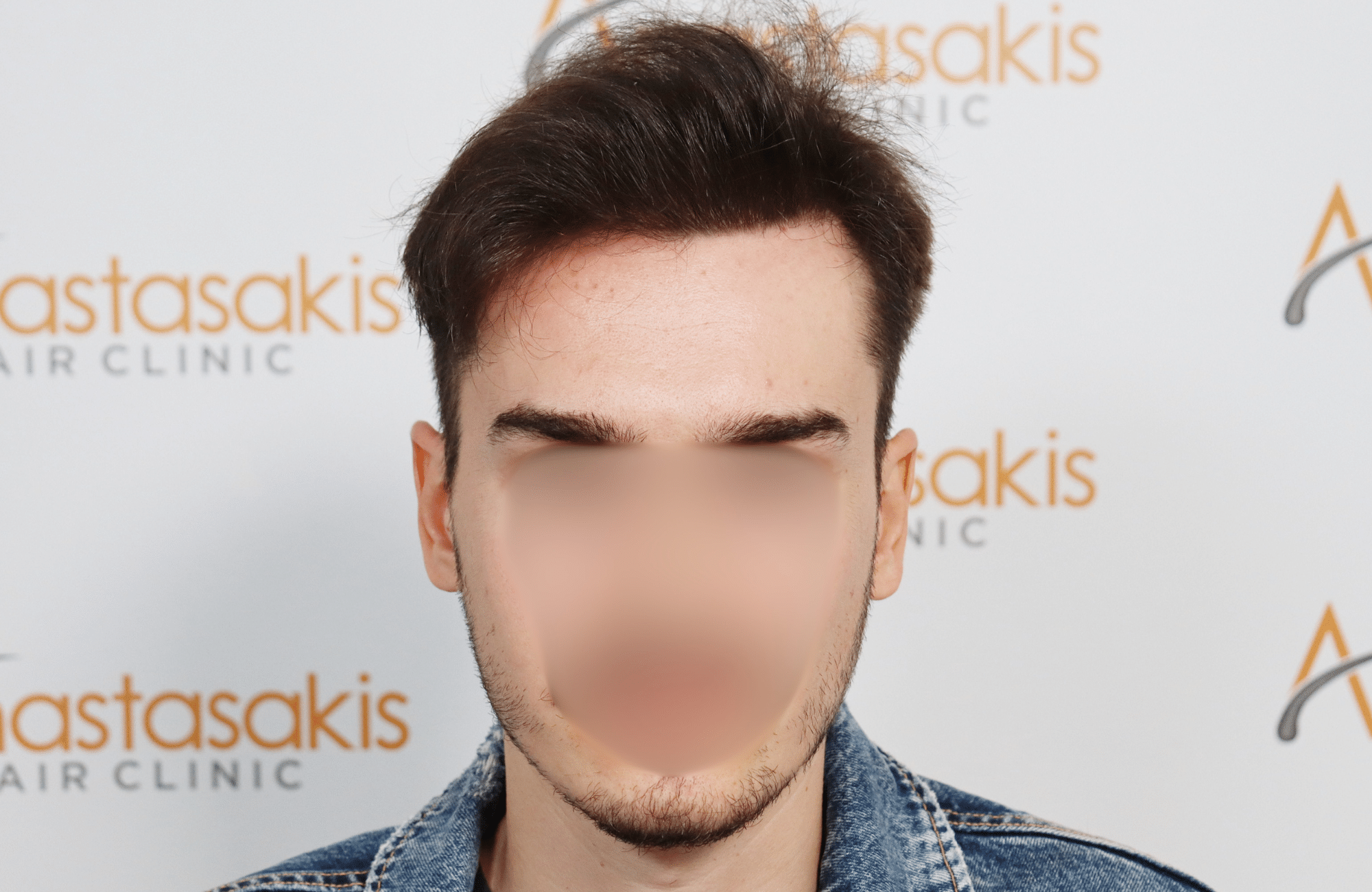 hair transplant result 2600 fus thick frontal stage 4 (3)