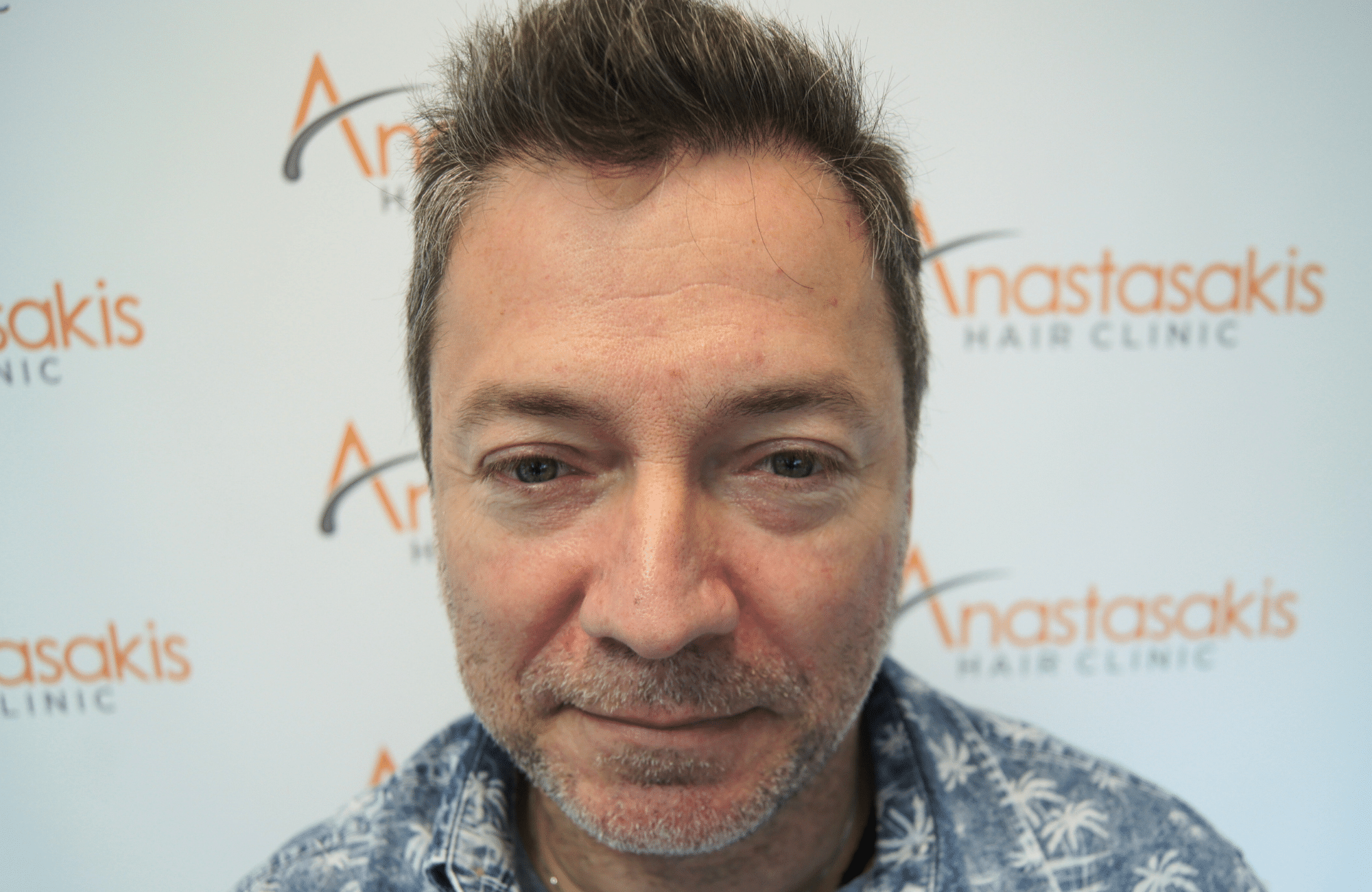 hair transplant result